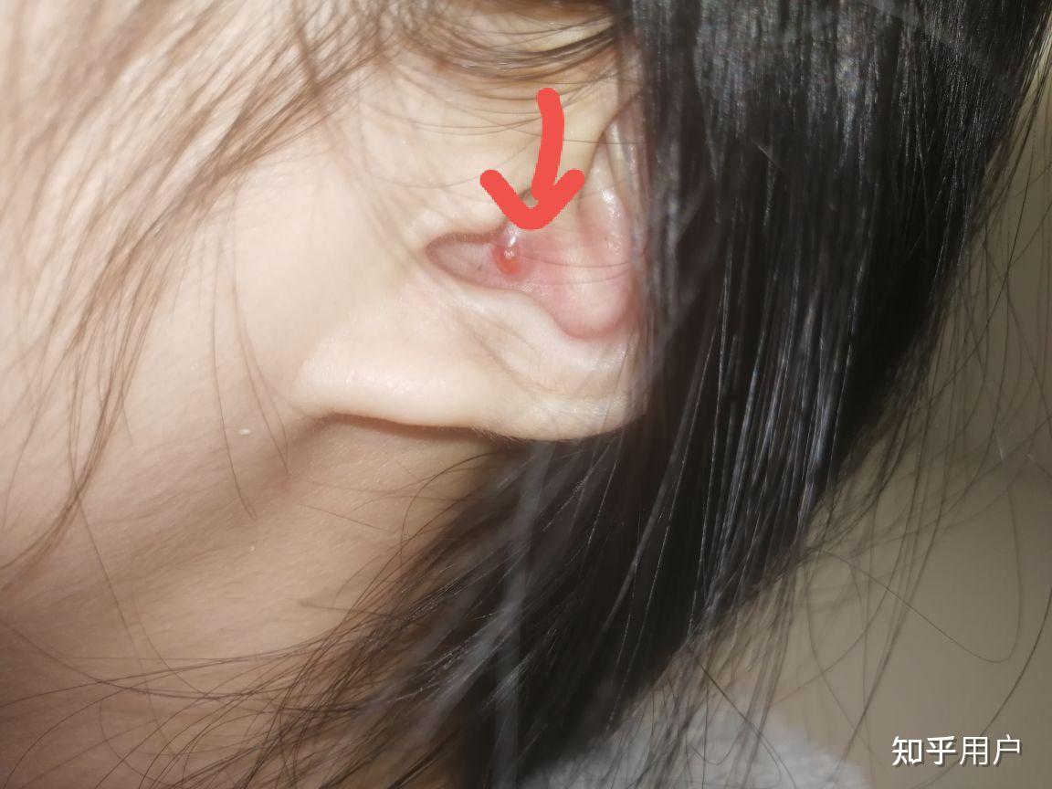 耳朵里长痘痘是一种什么体验? - 知乎