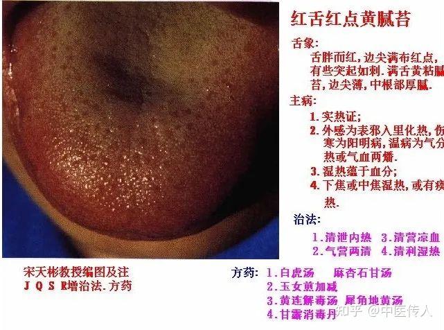 高清舌诊图解:各种临床证型舌象图谱大开眼界 - 知乎