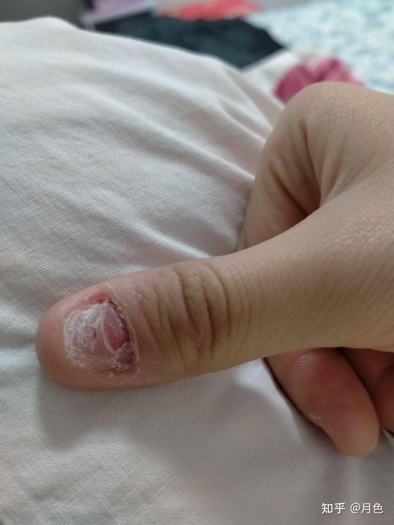 手经过长期的啃咬,变成了这样,千疮百孔,怎么办?很恶心很恐怖?