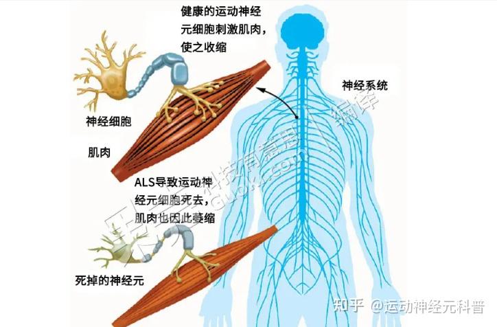 运动神经元早期能治好吗?最怕什么? - 知乎