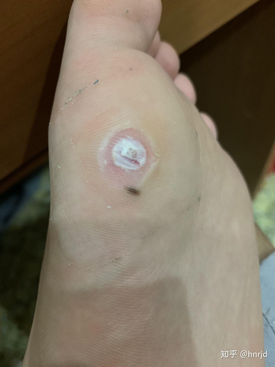 请问脚底长的这种洞洞是什么