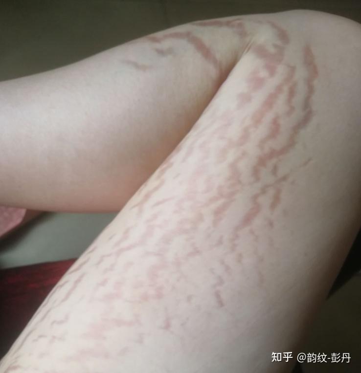 长肥胖纹是怎样一种体验? - 知乎