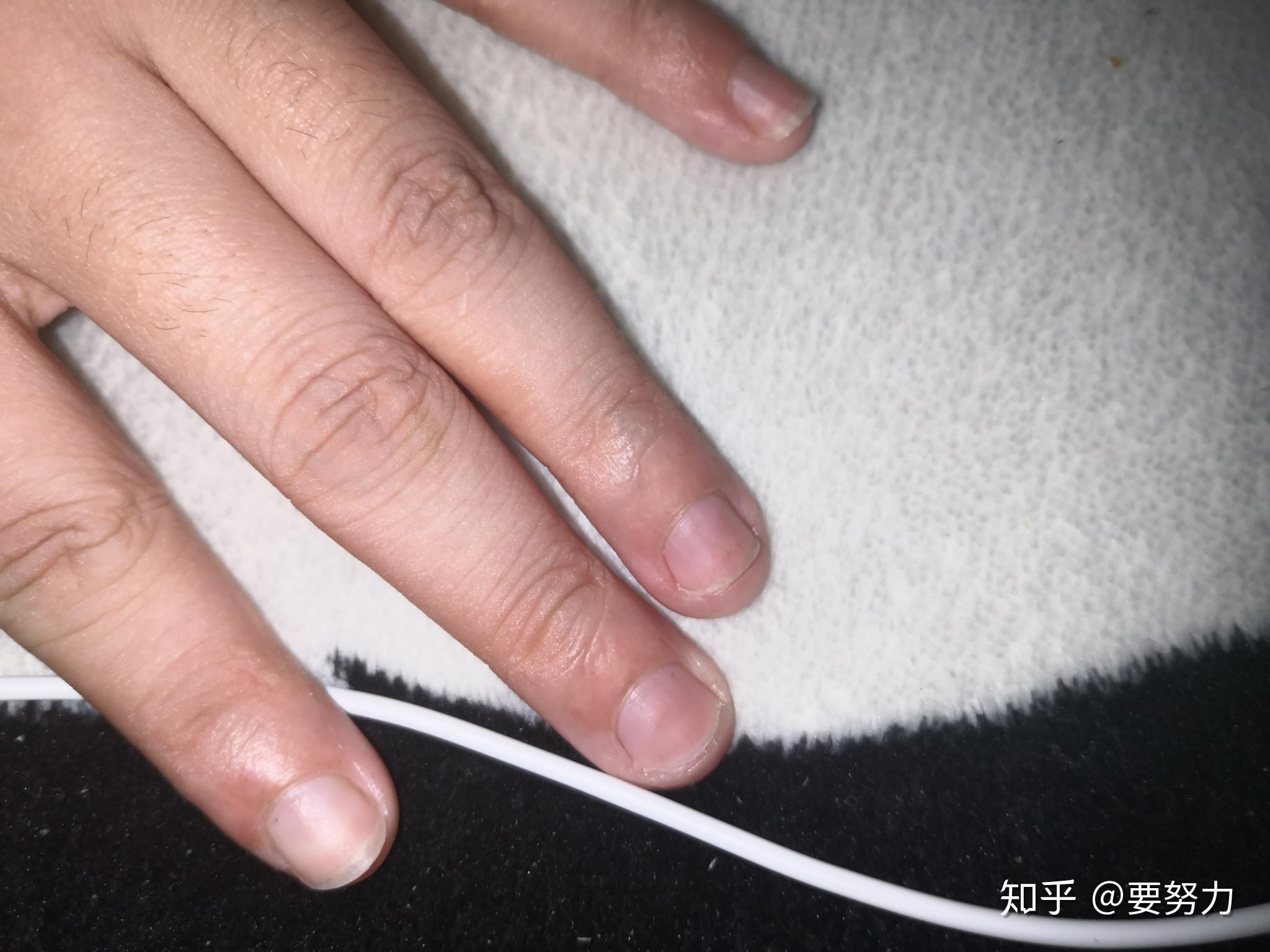 女生喜歡咬手倒刺和皮指啃指甲怎麼辦