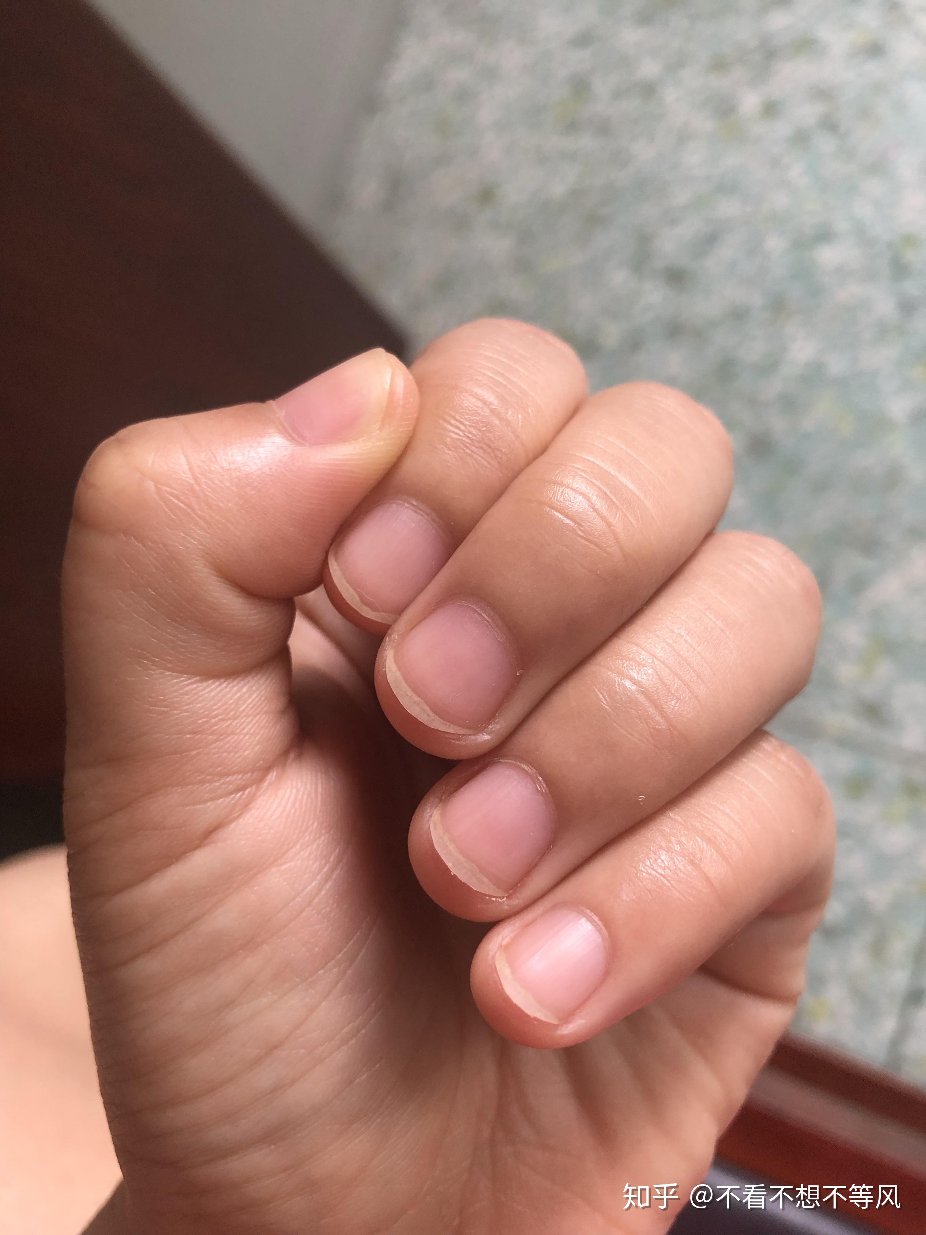 手指盖里面的月牙白能说明什么问题吗?