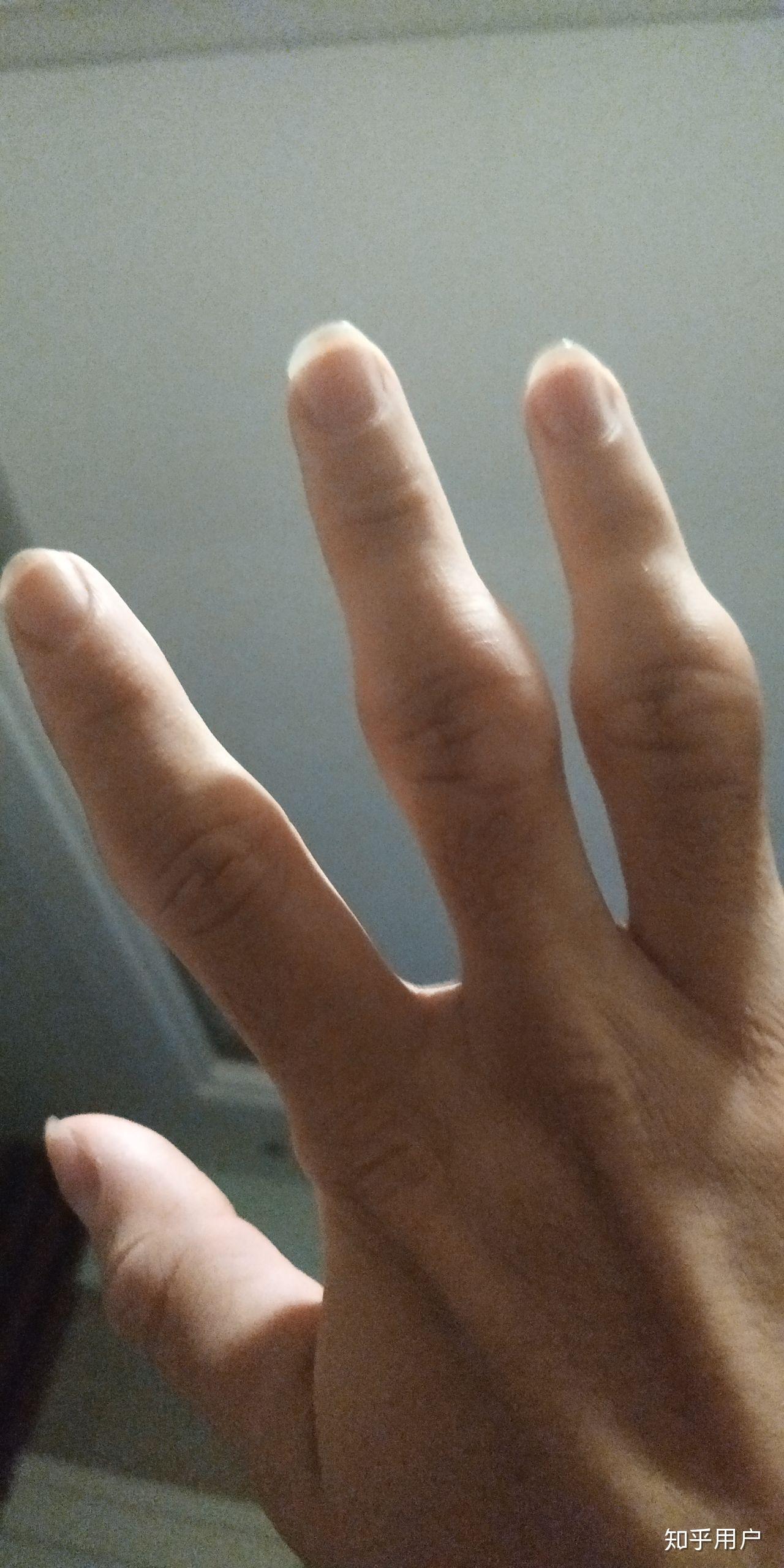 手指骨节大怎么办好像是当初不懂事按响造成的虽然很爽