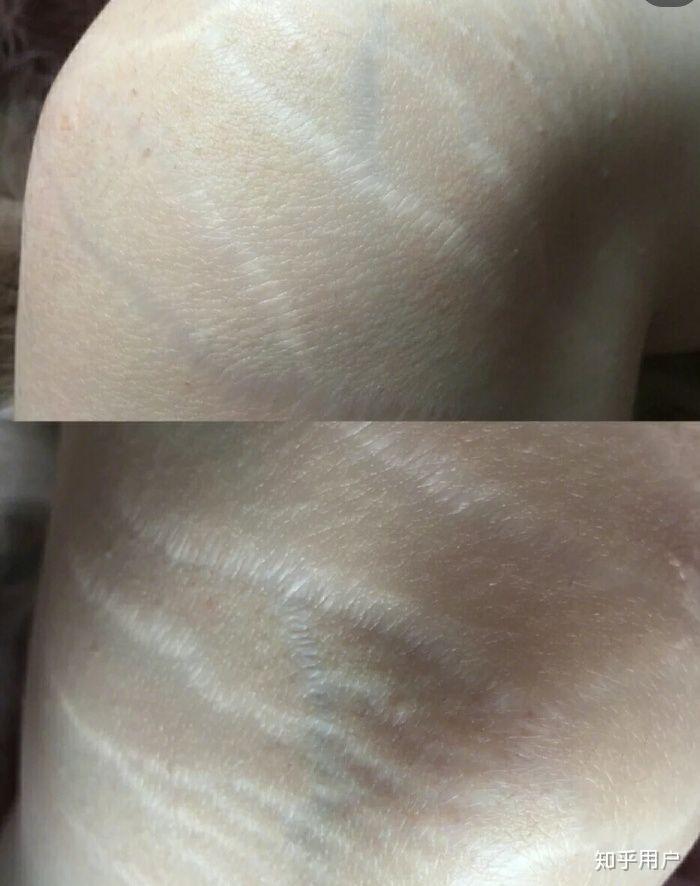 屁股上有生长纹会不会被嫌弃