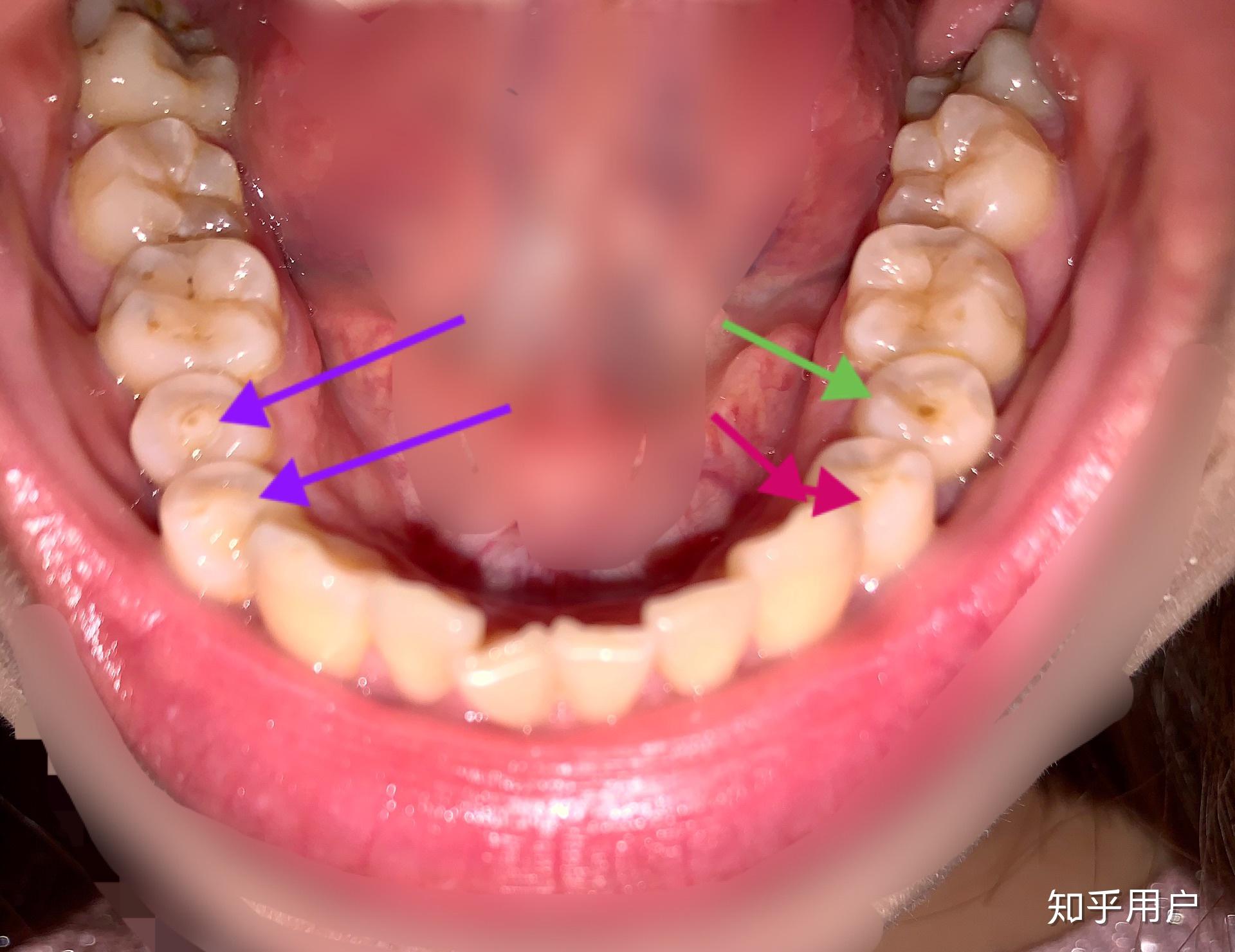 怎么处理畸形中央尖
