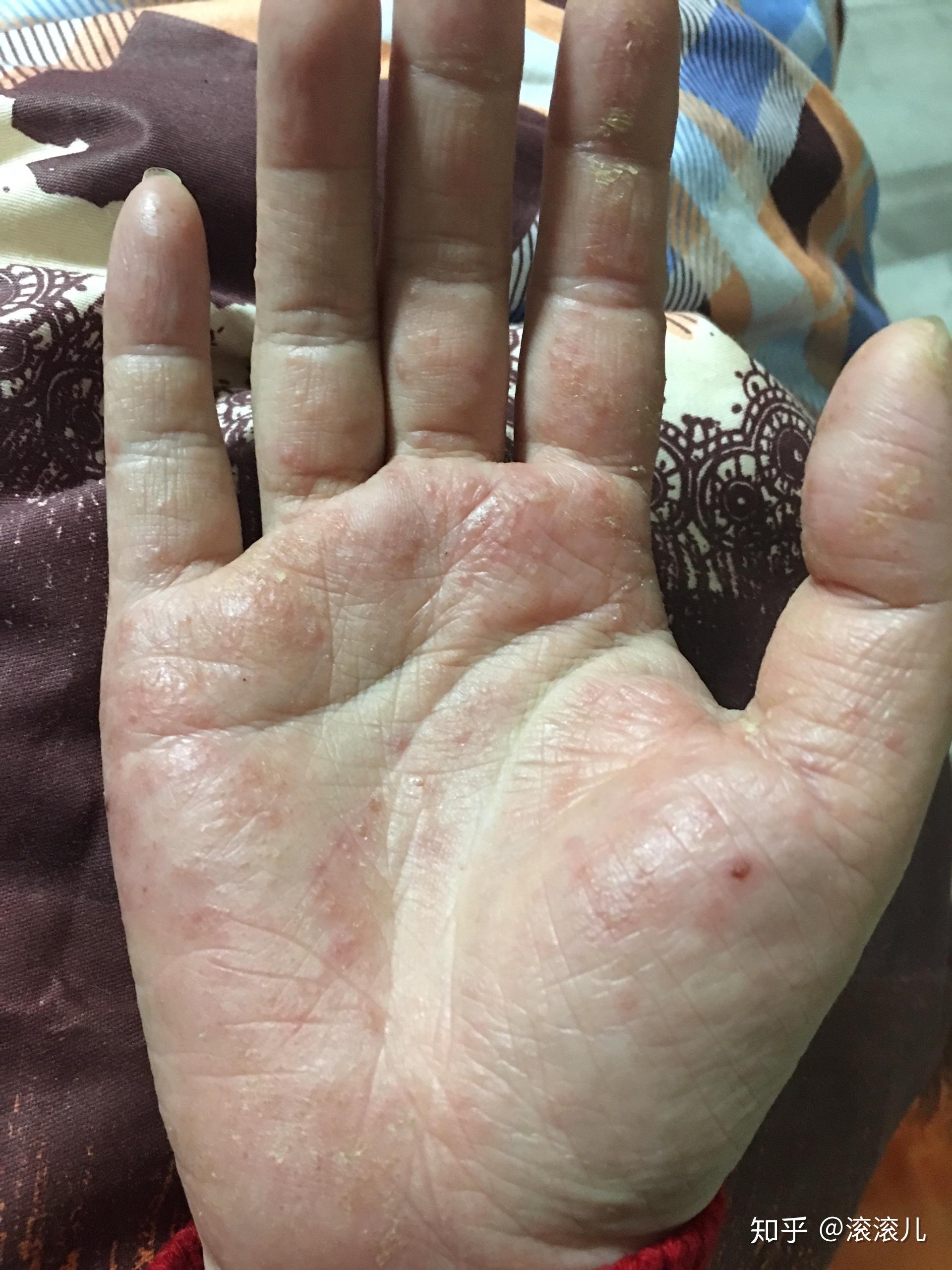 手部湿疹能根治吗? - 知乎