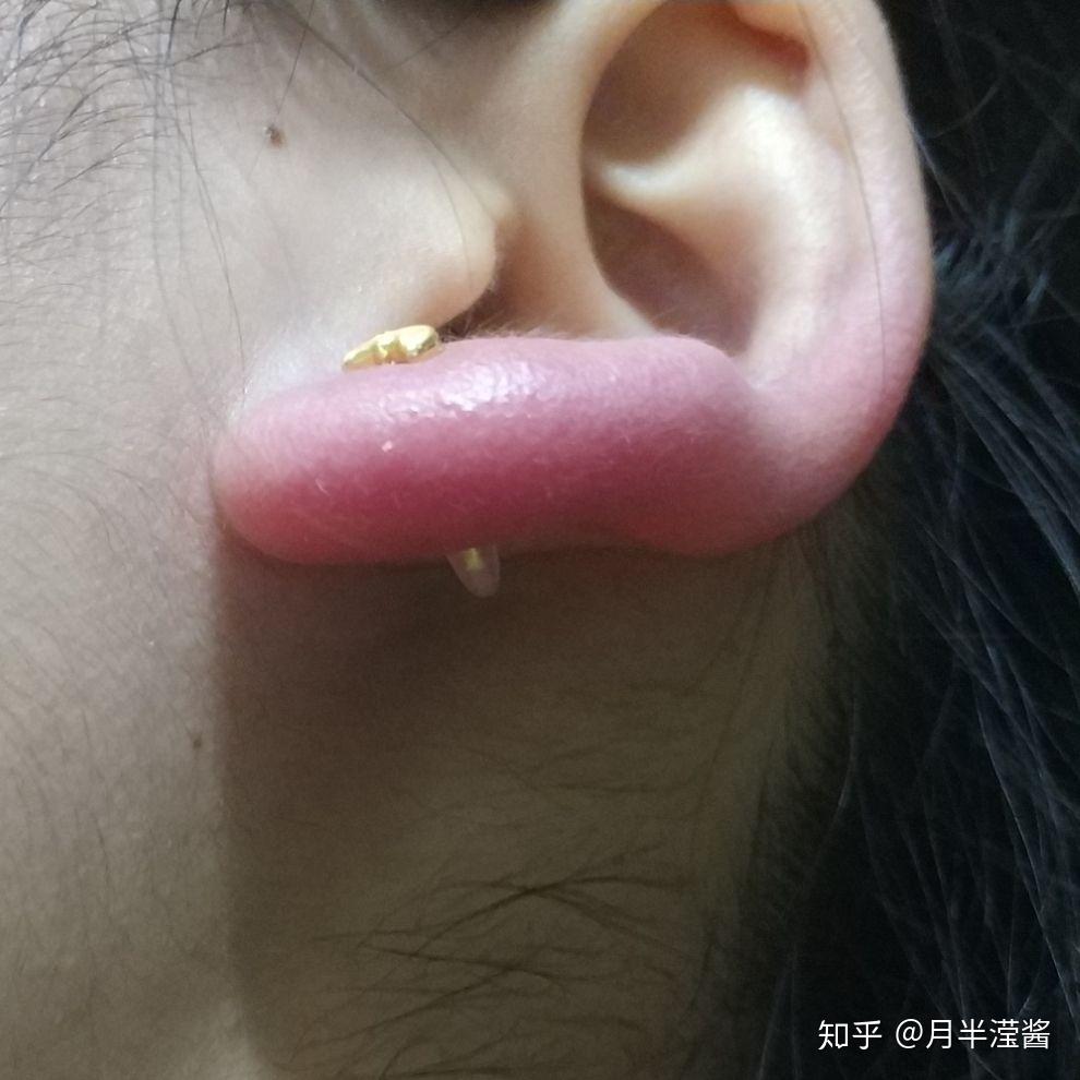 耳洞里面有小硬块耳钉带不上了该怎么办