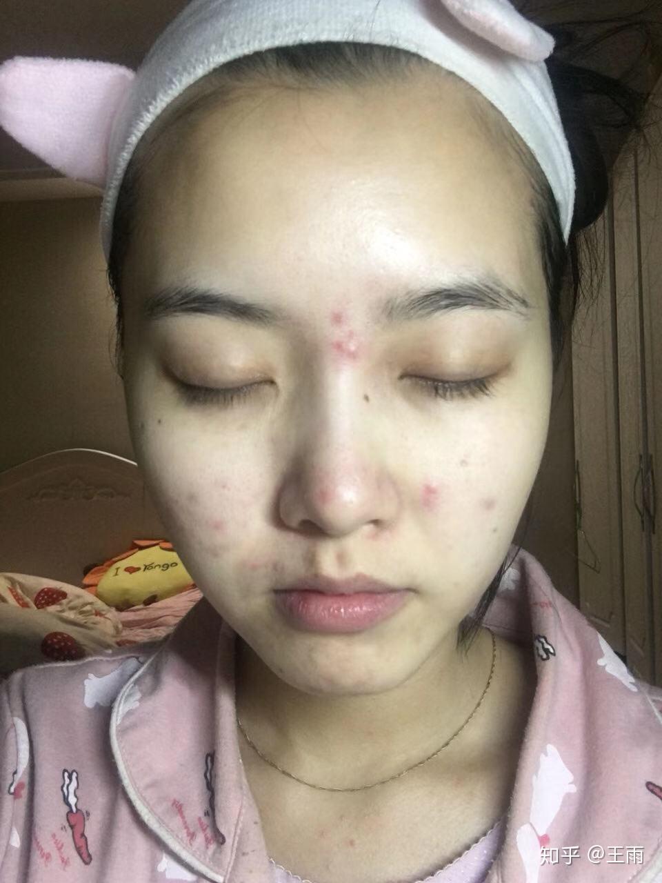 眉心长痘痘怎么回事啊两个眉毛之间的三角区总是冒痘怎么回事