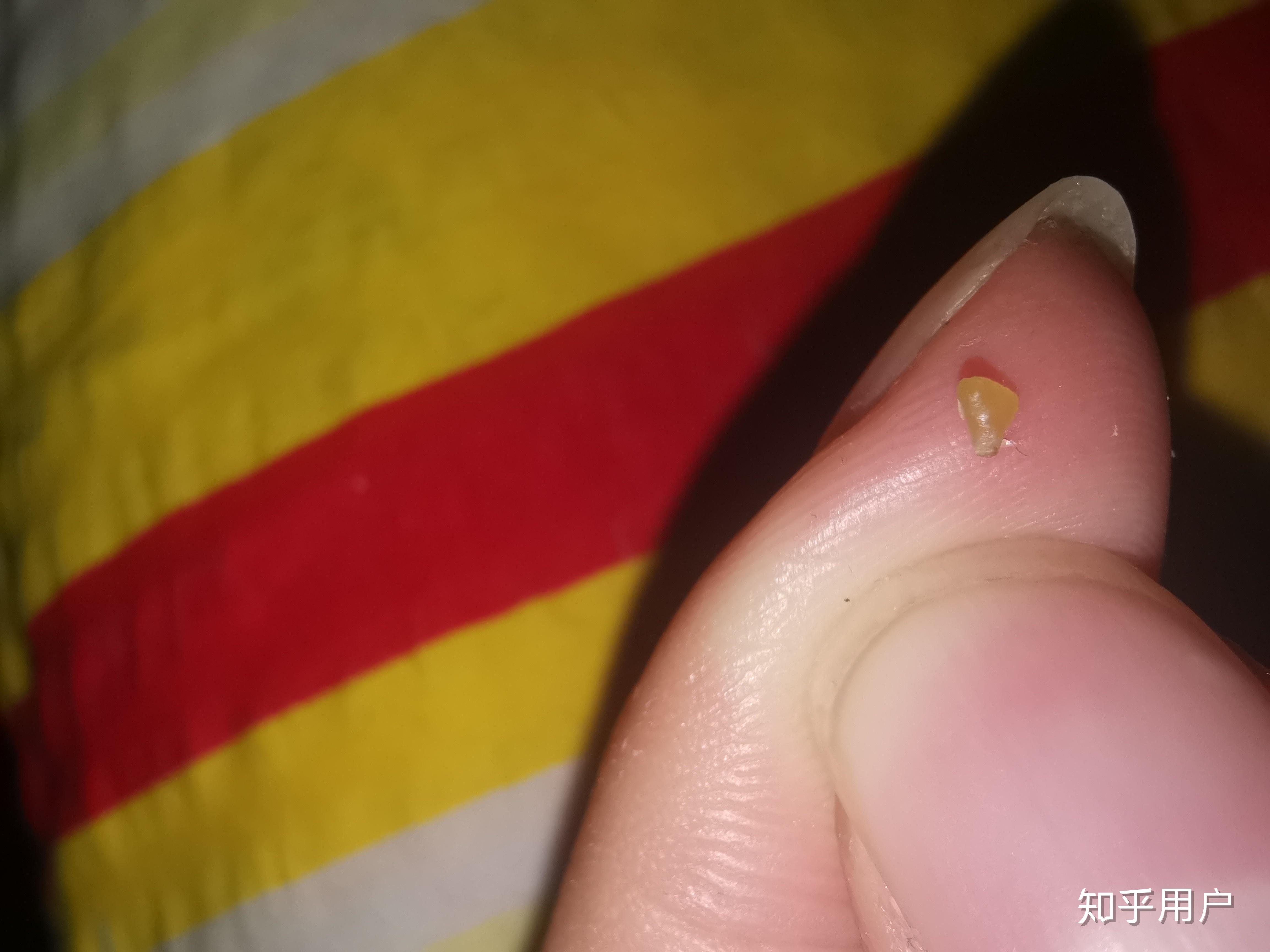 黑头大到直接挤出来是什么感受?