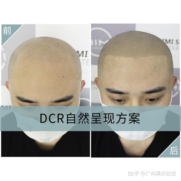 黑米3D纹发：为什么纹发？因为长不出来了！ - 知乎