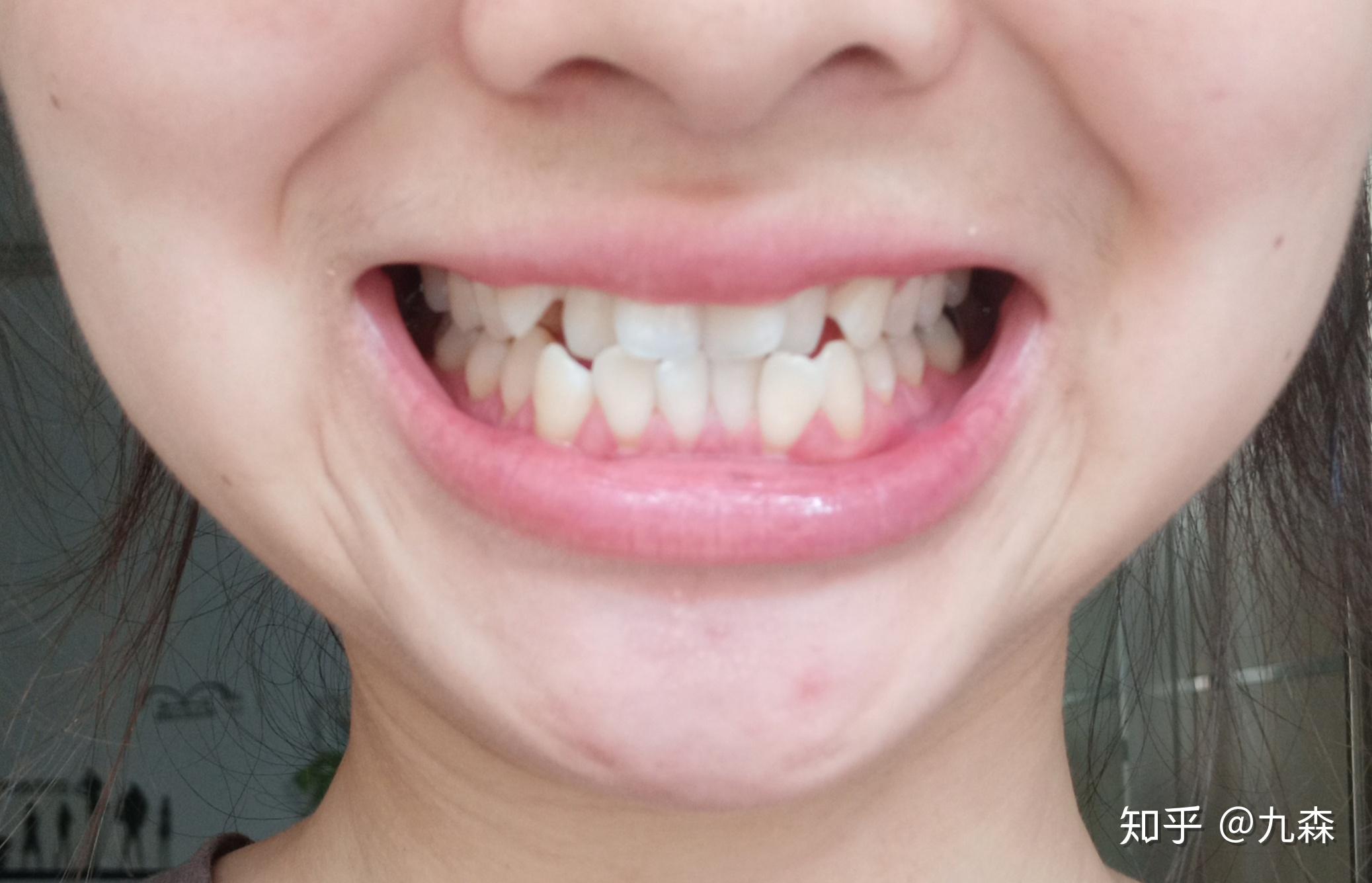 有人做过龈下刮治吗