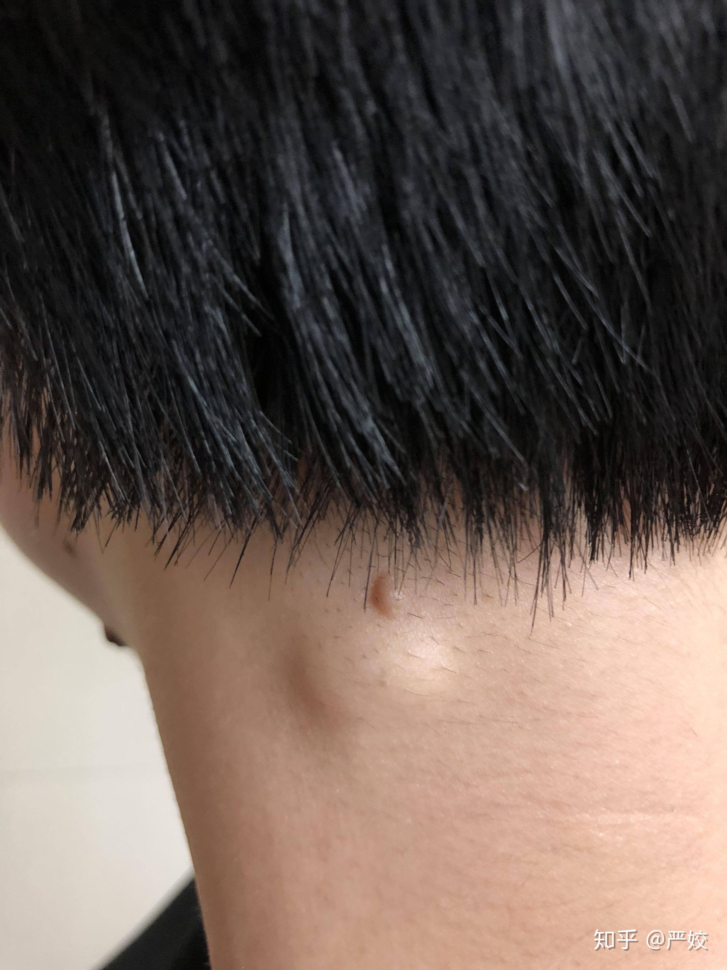 粉瘤如果不恶化,不做手术行不行?