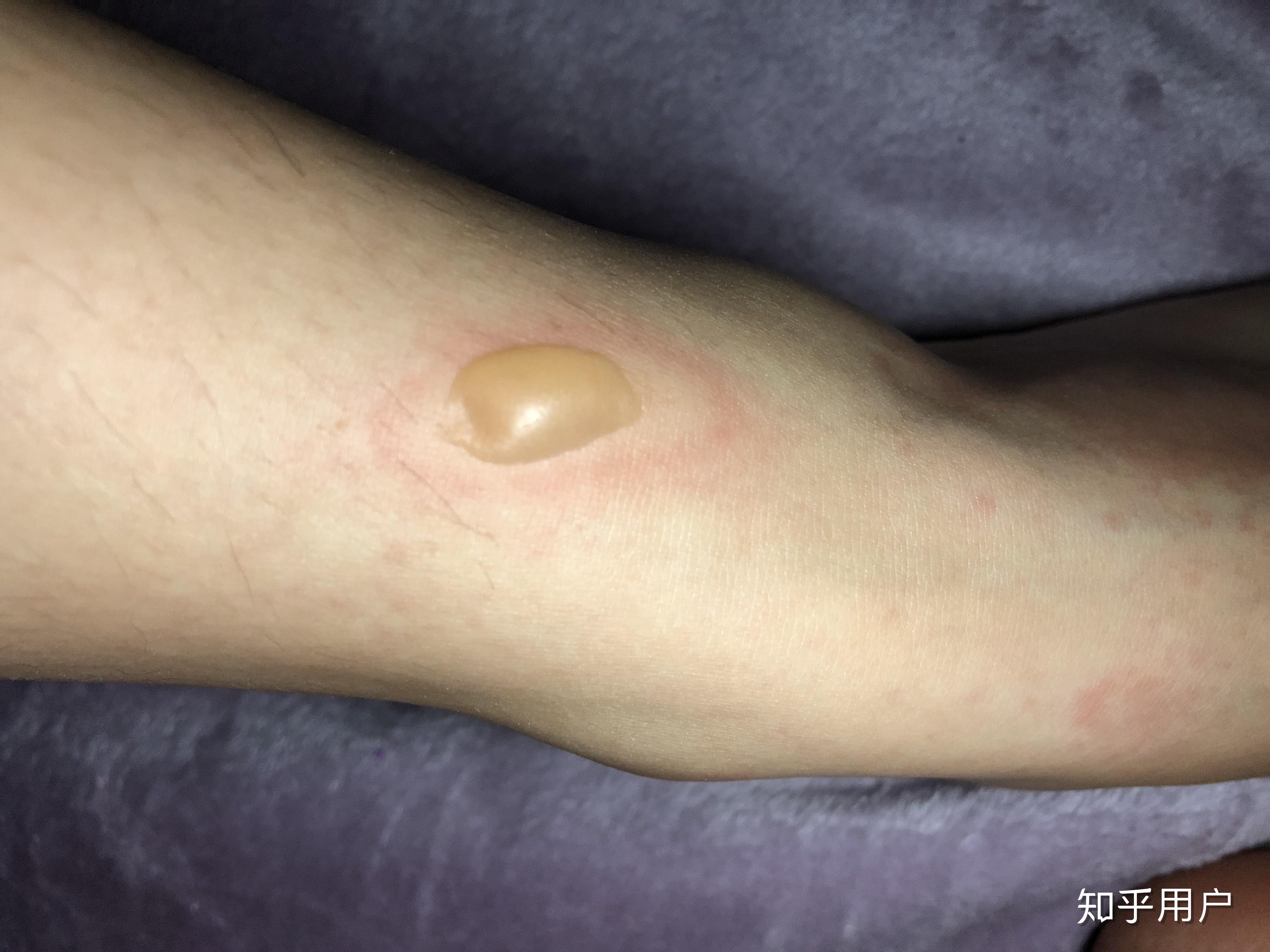 被毒蚊子咬了 肿了很大一个包 还很硬 之后肿的包上面起了水泡 挑破