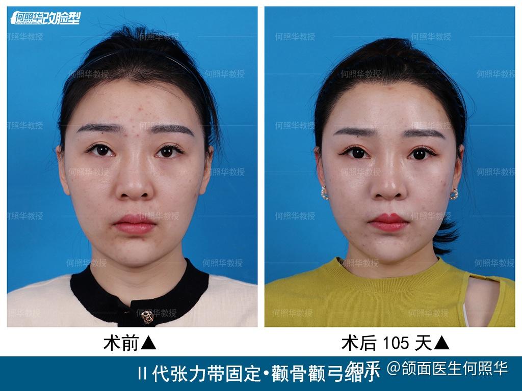 颧骨和颧弓有什么区别,颧弓外扩和颧骨高对脸型分别是什么样的影响? - 知乎