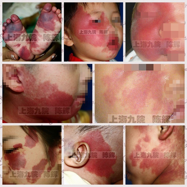 胎记的形成原因是什么对人体有什么影响吗