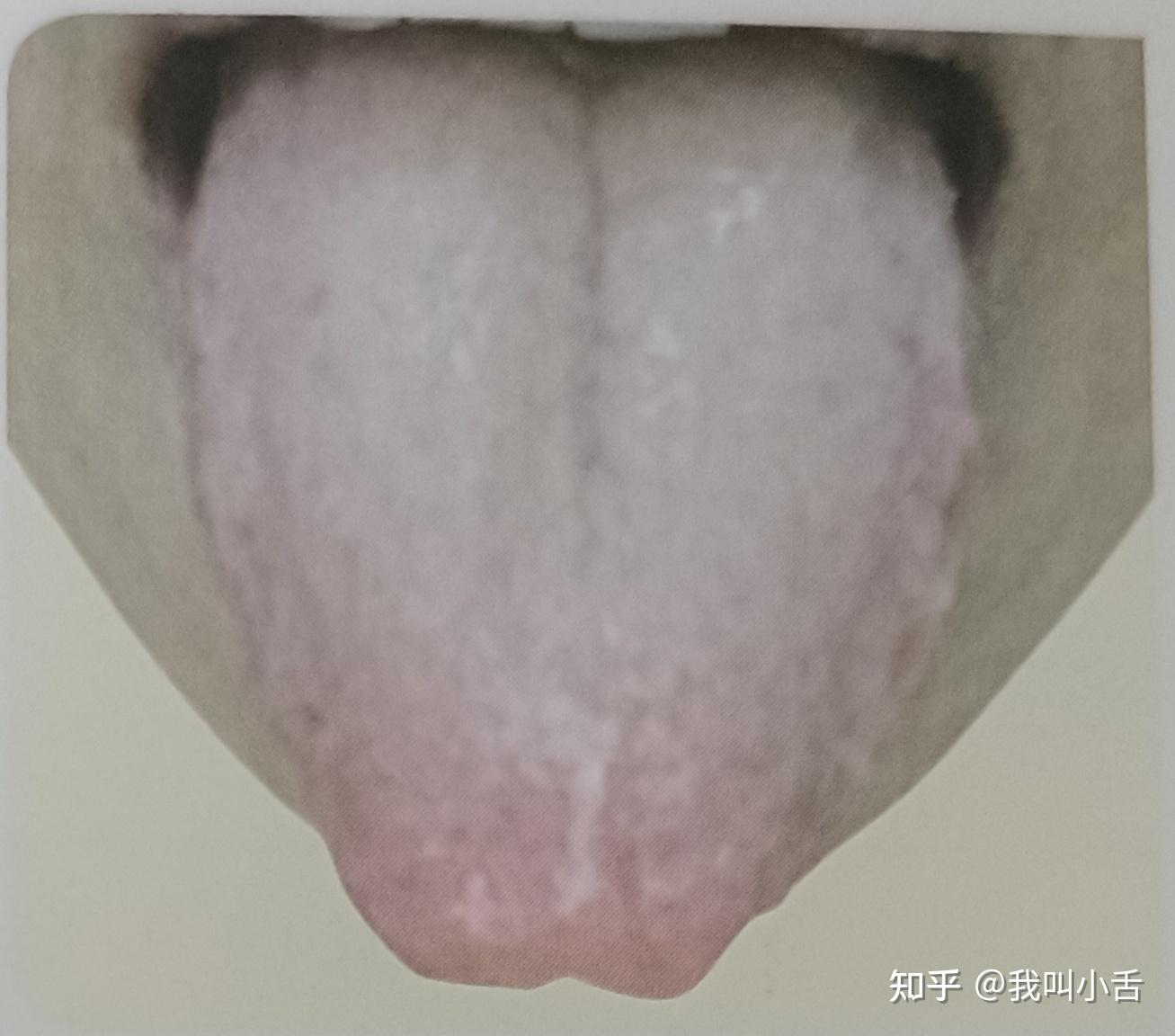 舌苔是如何形成的？白苔长什么样？如何判断自己的舌象呢？智能舌象助手来帮你！ - 知乎
