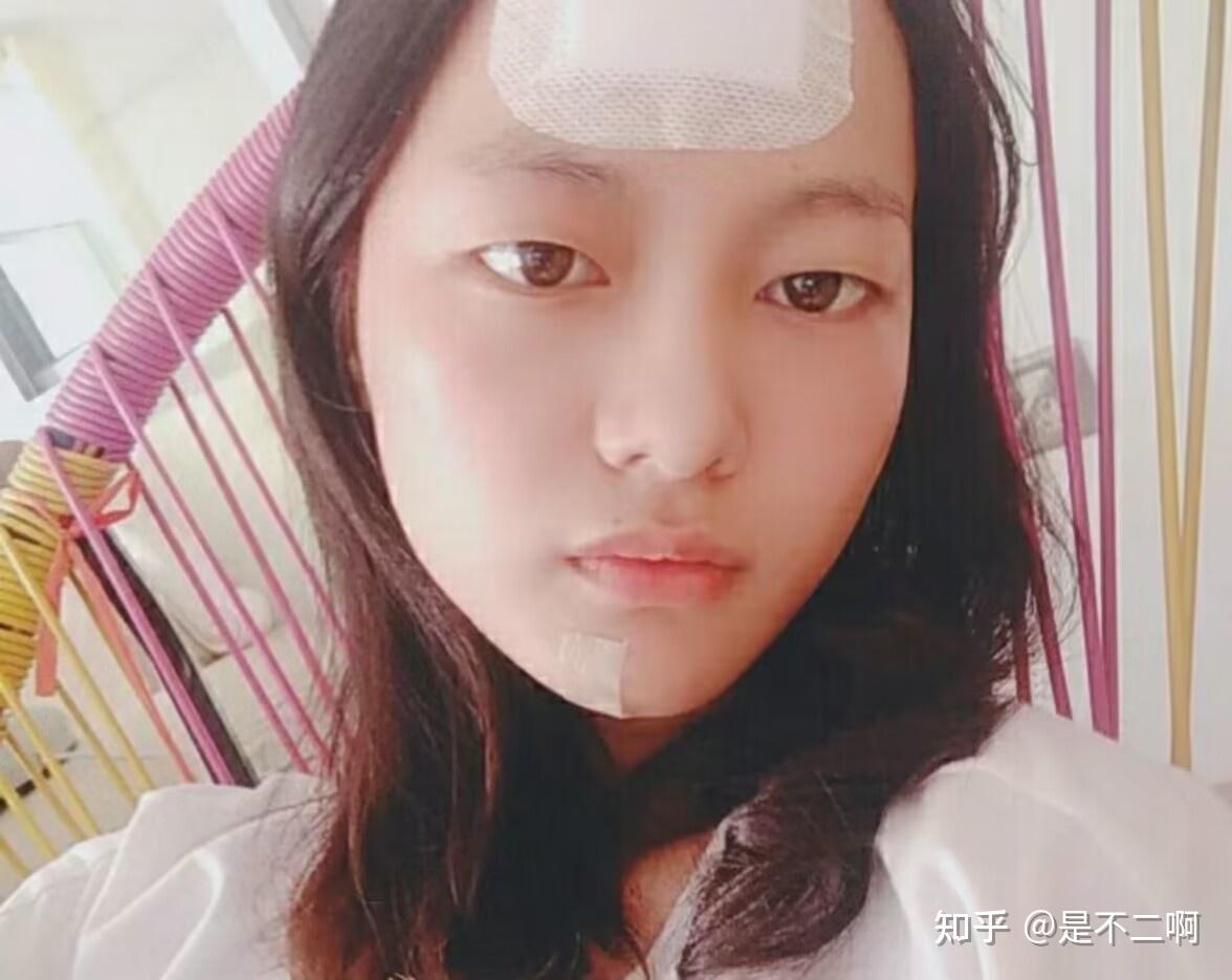 被医生判定脸上永久留疤,但我却用医用硅酮拯救了我自己,真实记录磕伤疤2个月淡化 - 知乎