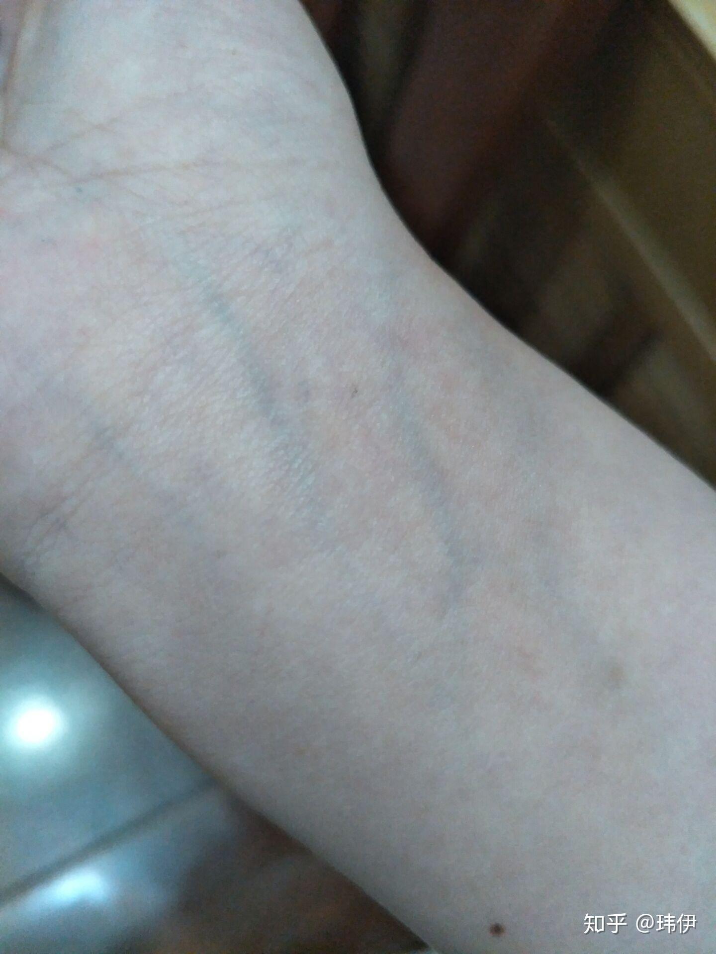 手腕上静脉颜色很明显是身体有什么病症的原因吗