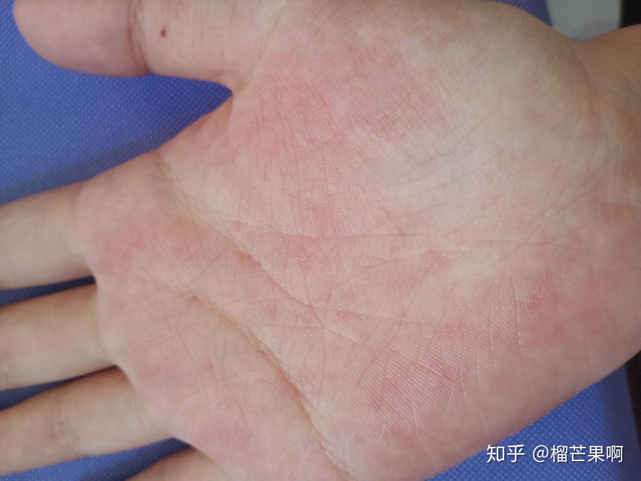 夏天手上总是起汗孢疹基本年年都会复发怎样才能根治呢