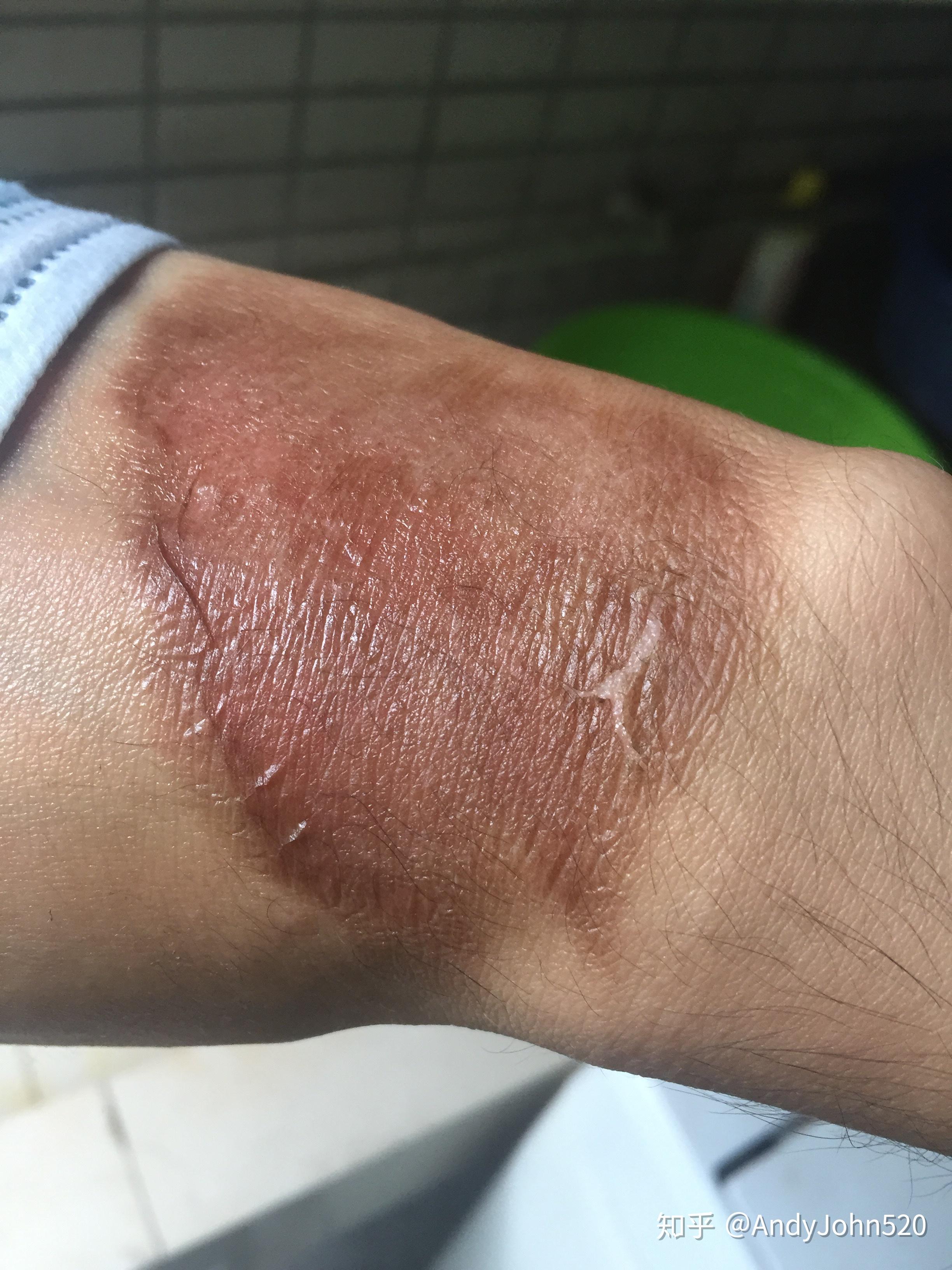 手被开水烫伤了怎么办