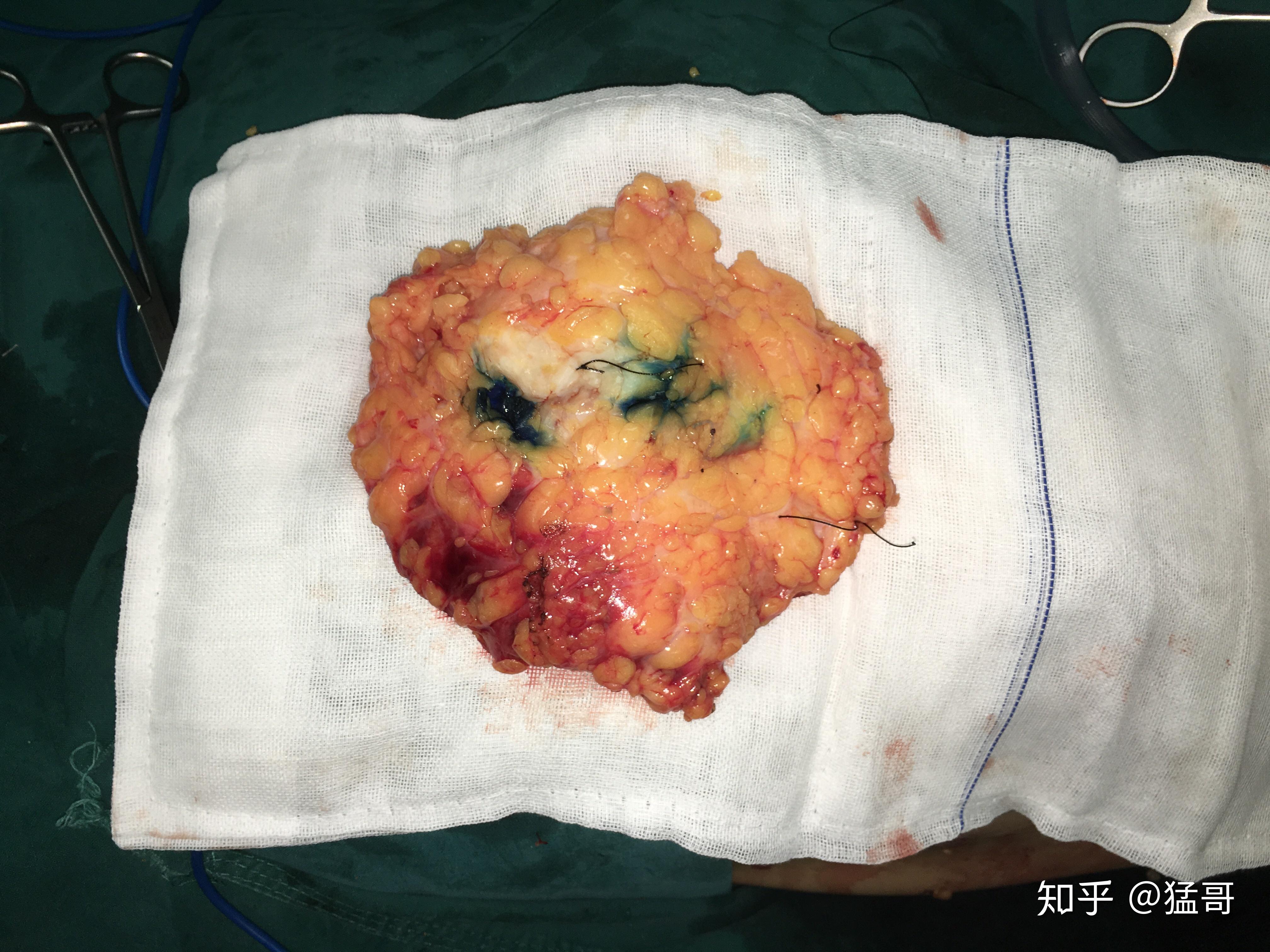 通过手术取下的癌组织是什么样子的? - 知乎