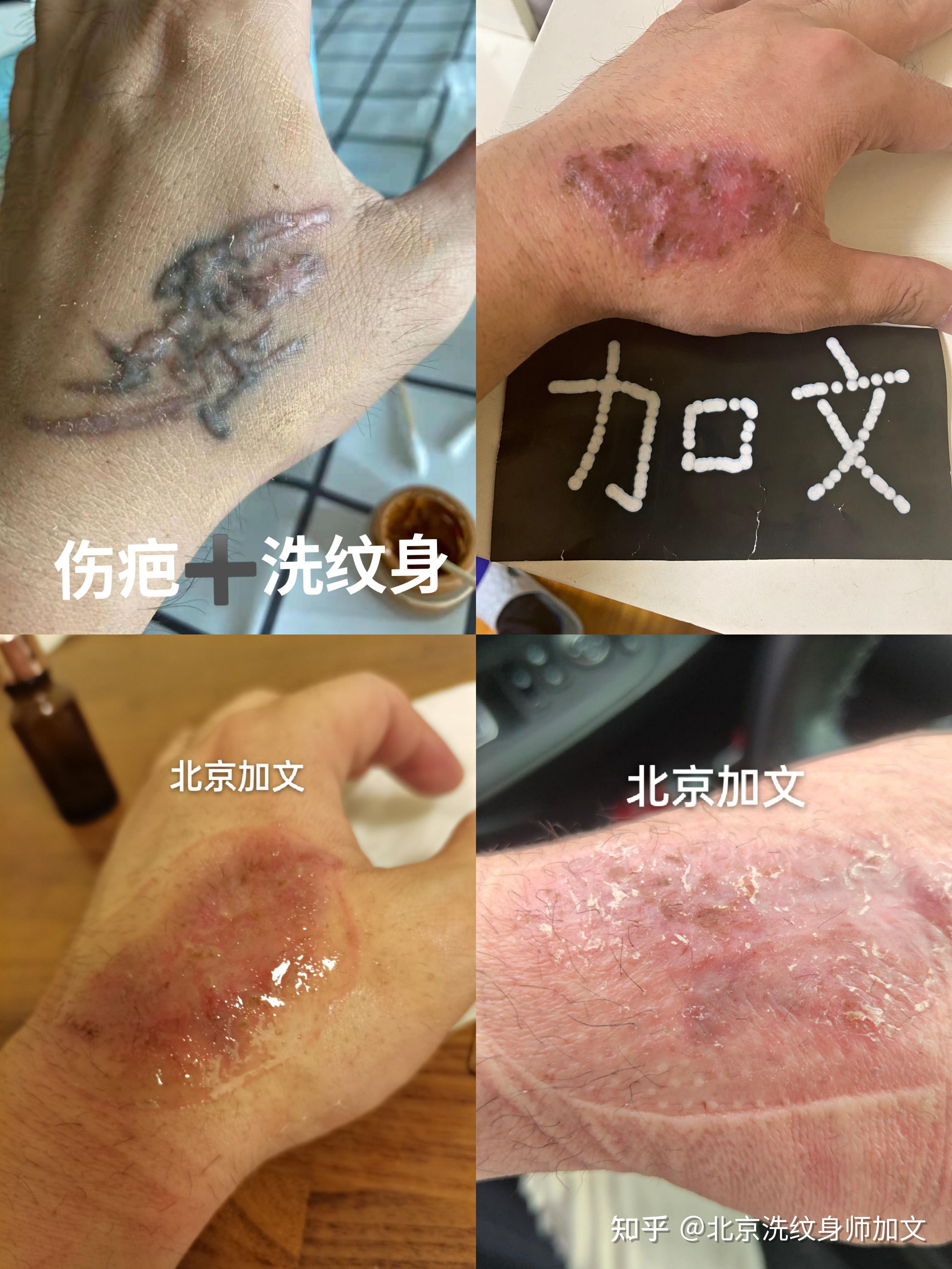 皮秒洗纹身从1-15天的恢复过程 - 知乎
