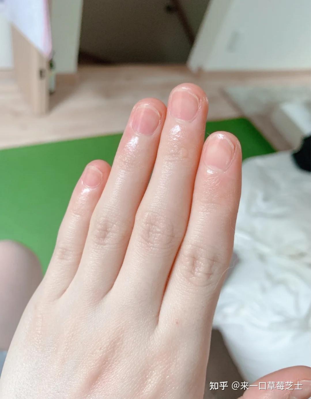 女生手指关节发黑何解决