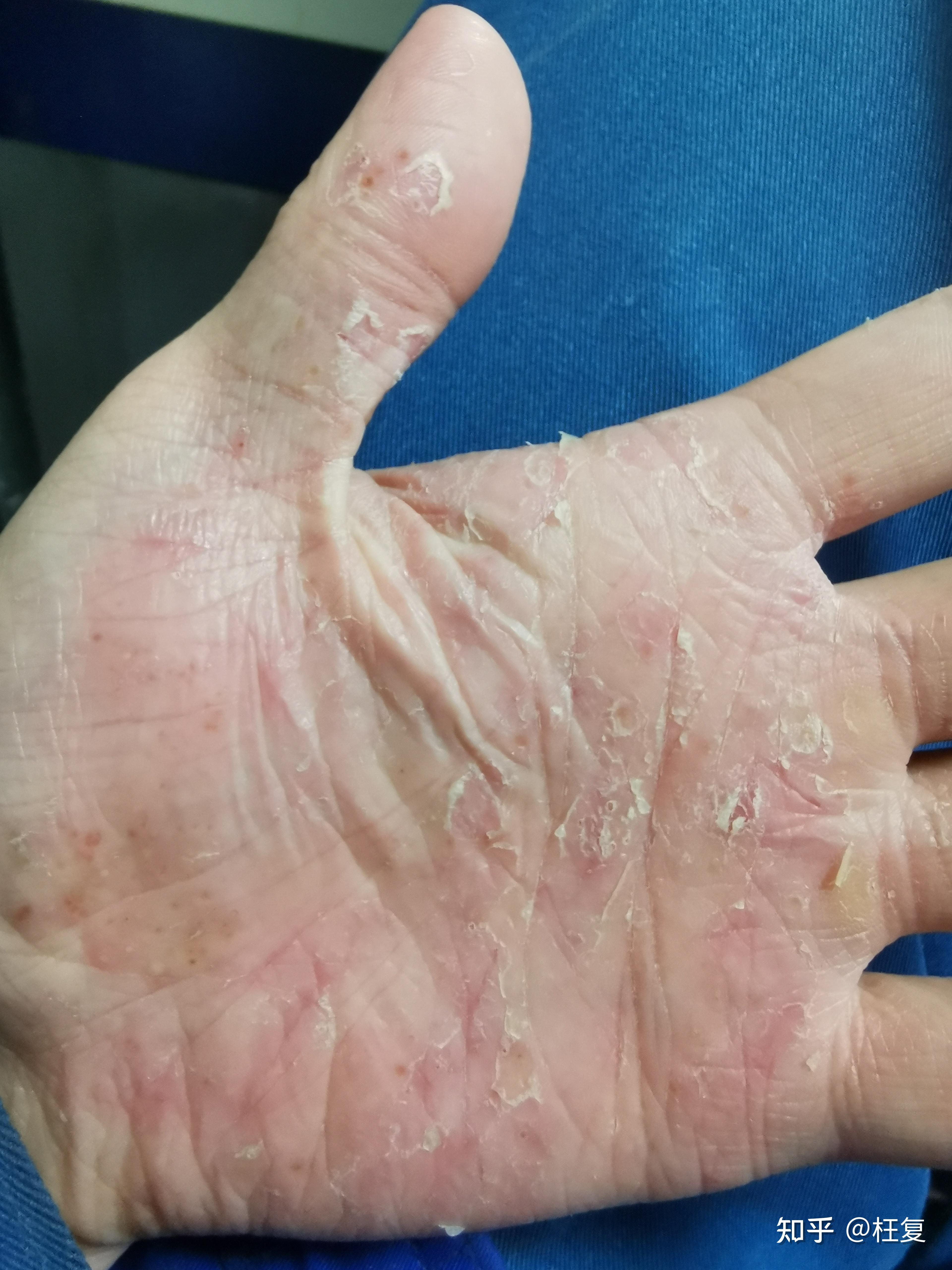 汗疱疹是什么体验