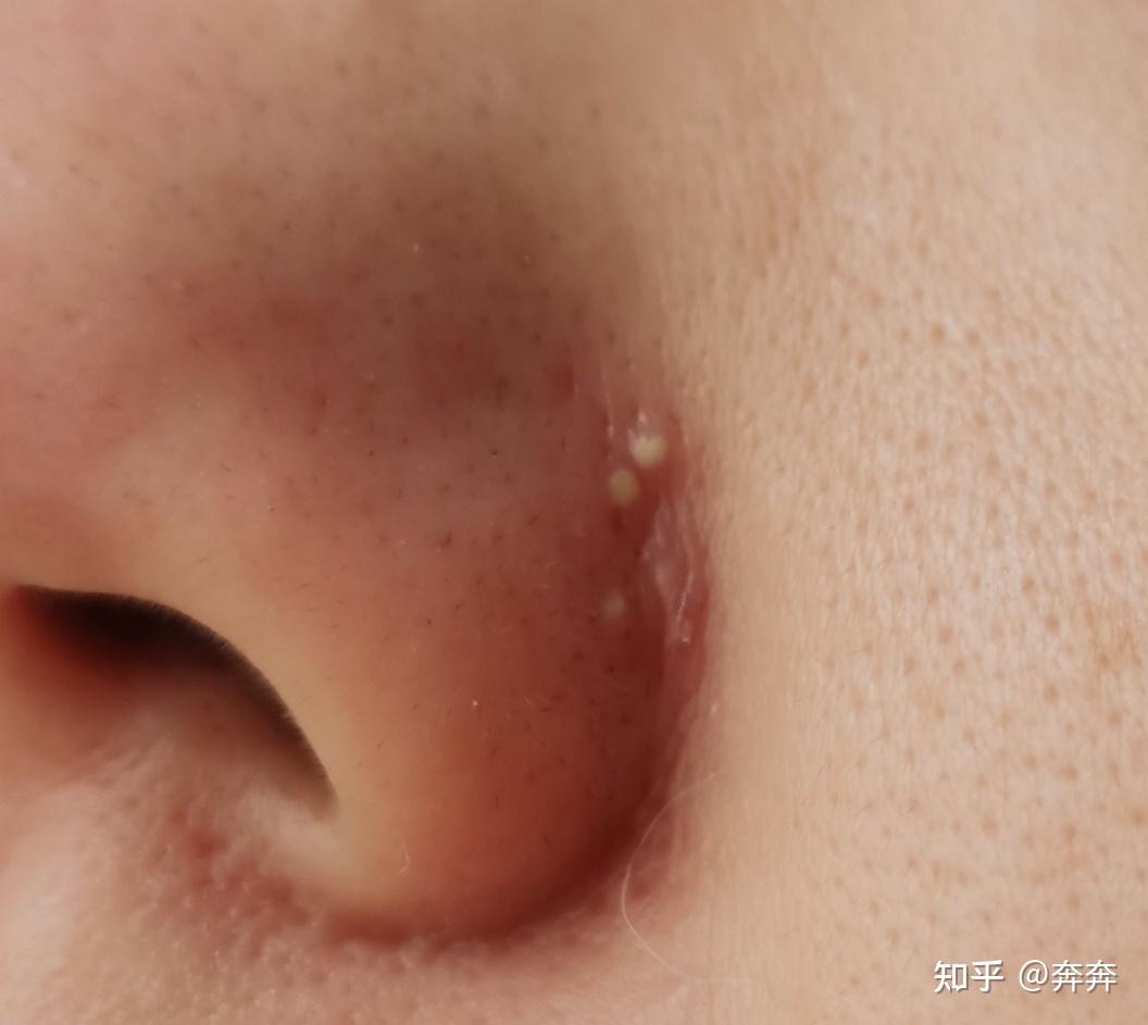 鼻翼长痘痘是什么原因鼻翼长痘痘怎么消除