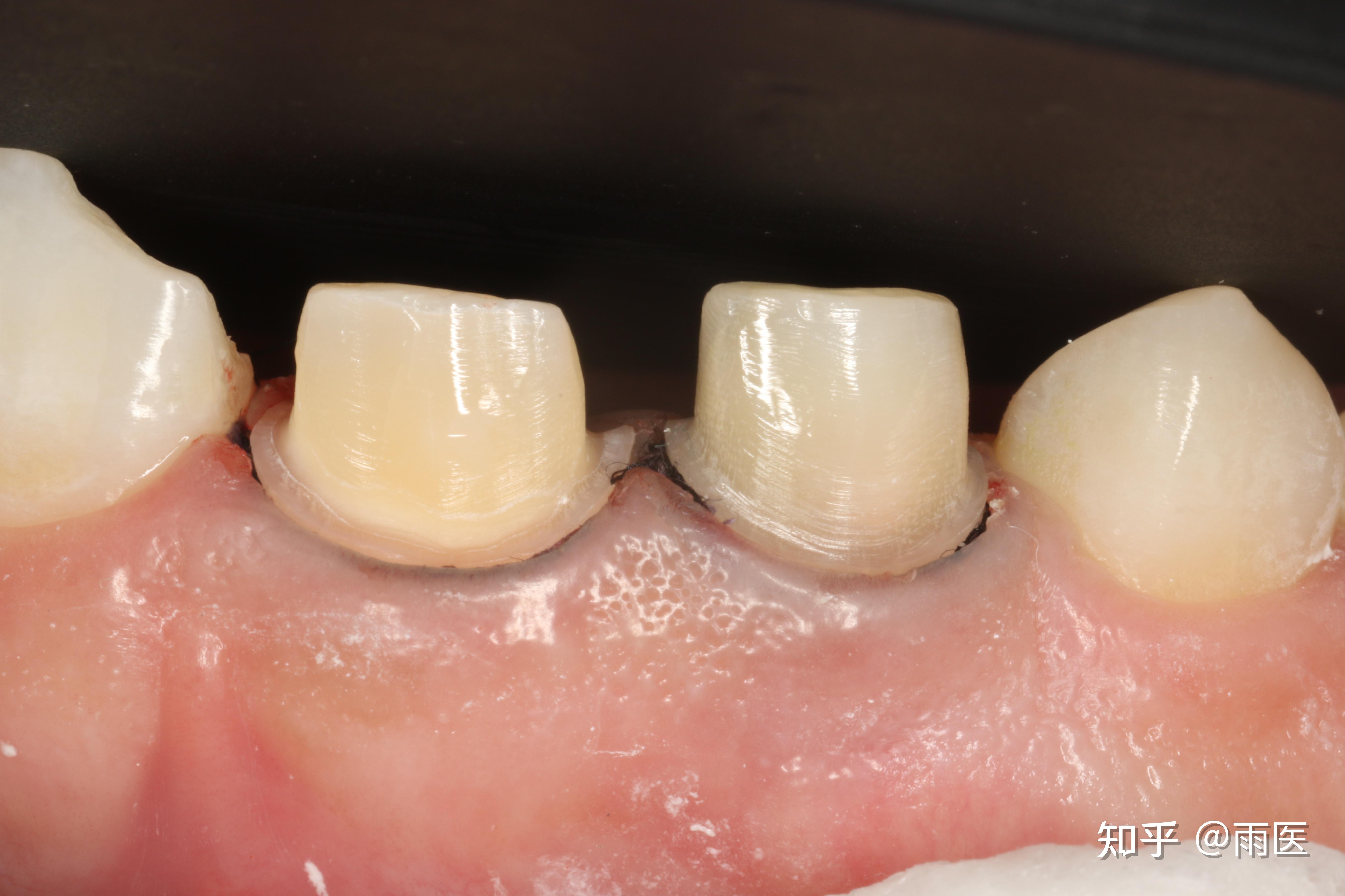 烤瓷牙里面的基牙如何防腐烂? - 知乎