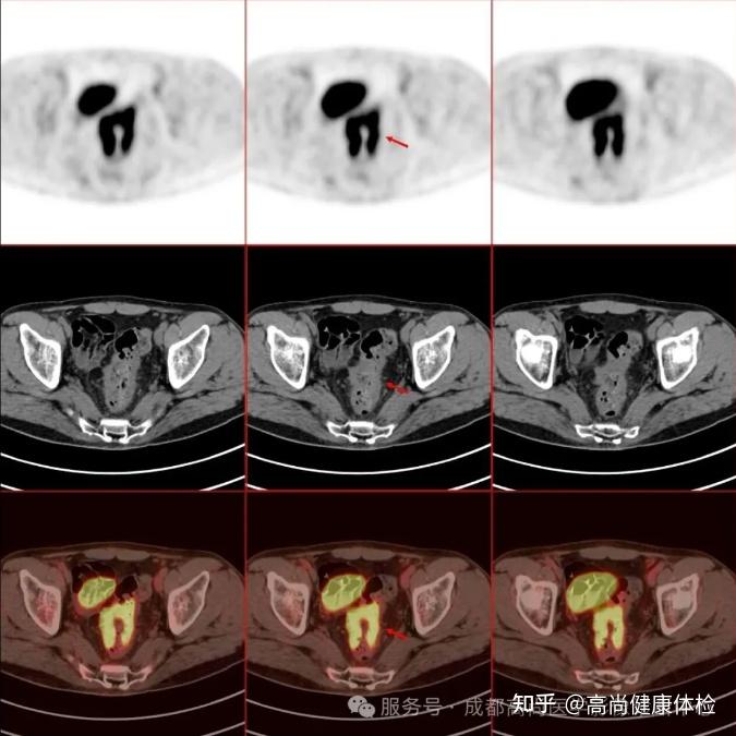 47岁男大便不成形发现直肠腺癌,18F-FDG PET/CT联合HR-MR评估全身情况 - 知乎