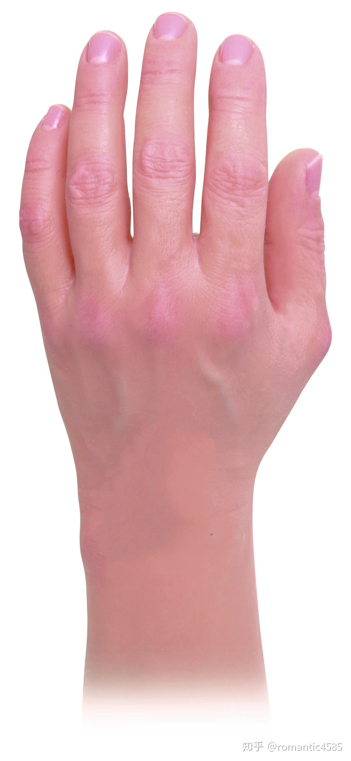 侄女九岁左手臂截肢如何进行康复治疗及心理调整