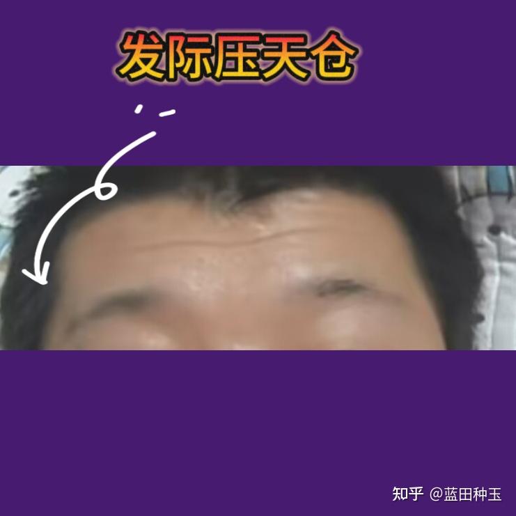 面相图文分享––发际压天仓 - 知乎