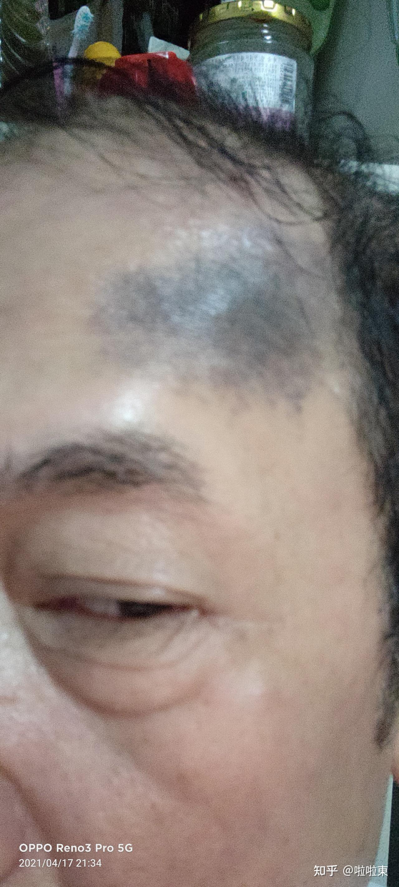 额头两侧发黑是怎么回事