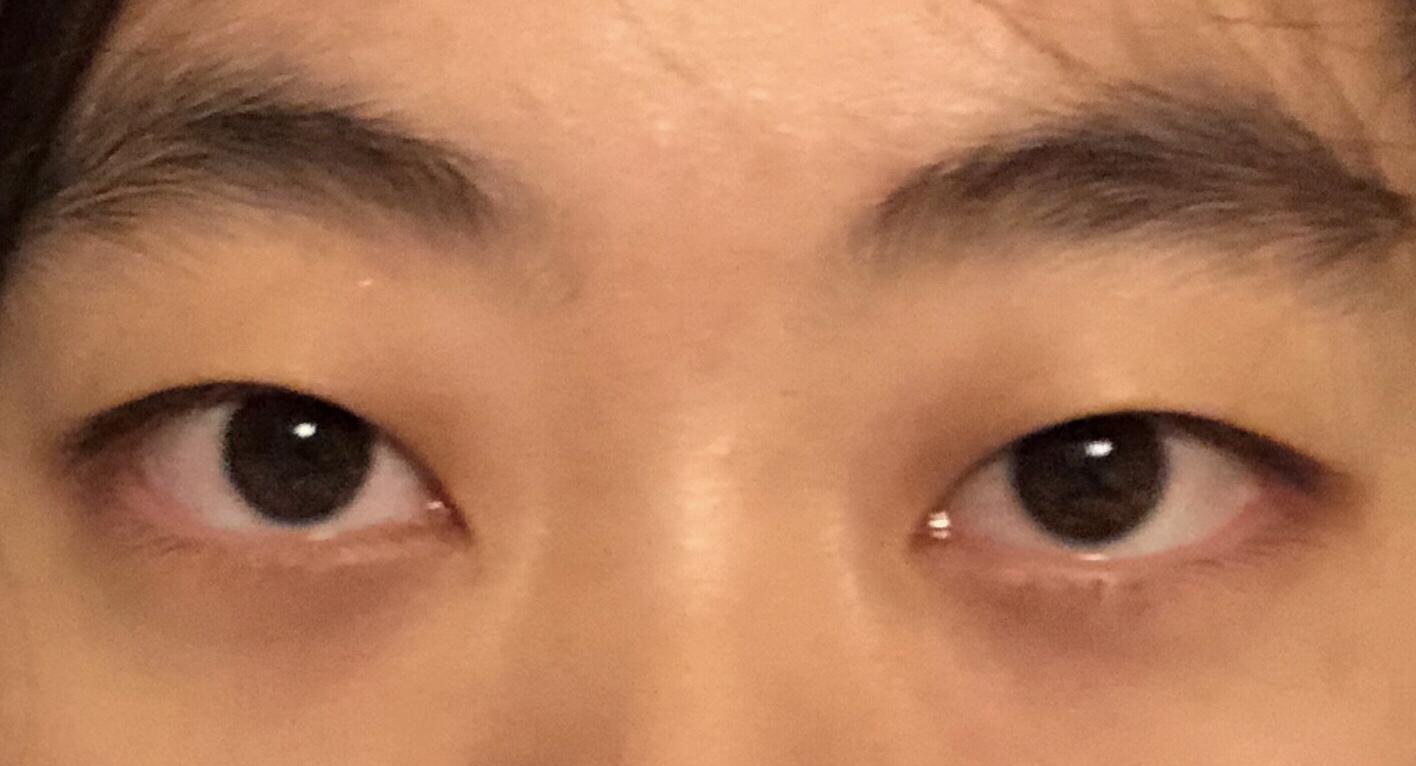 侧面看眼睛非常突,眉骨低和鼻子连接不起来是怎么回事? - 知乎