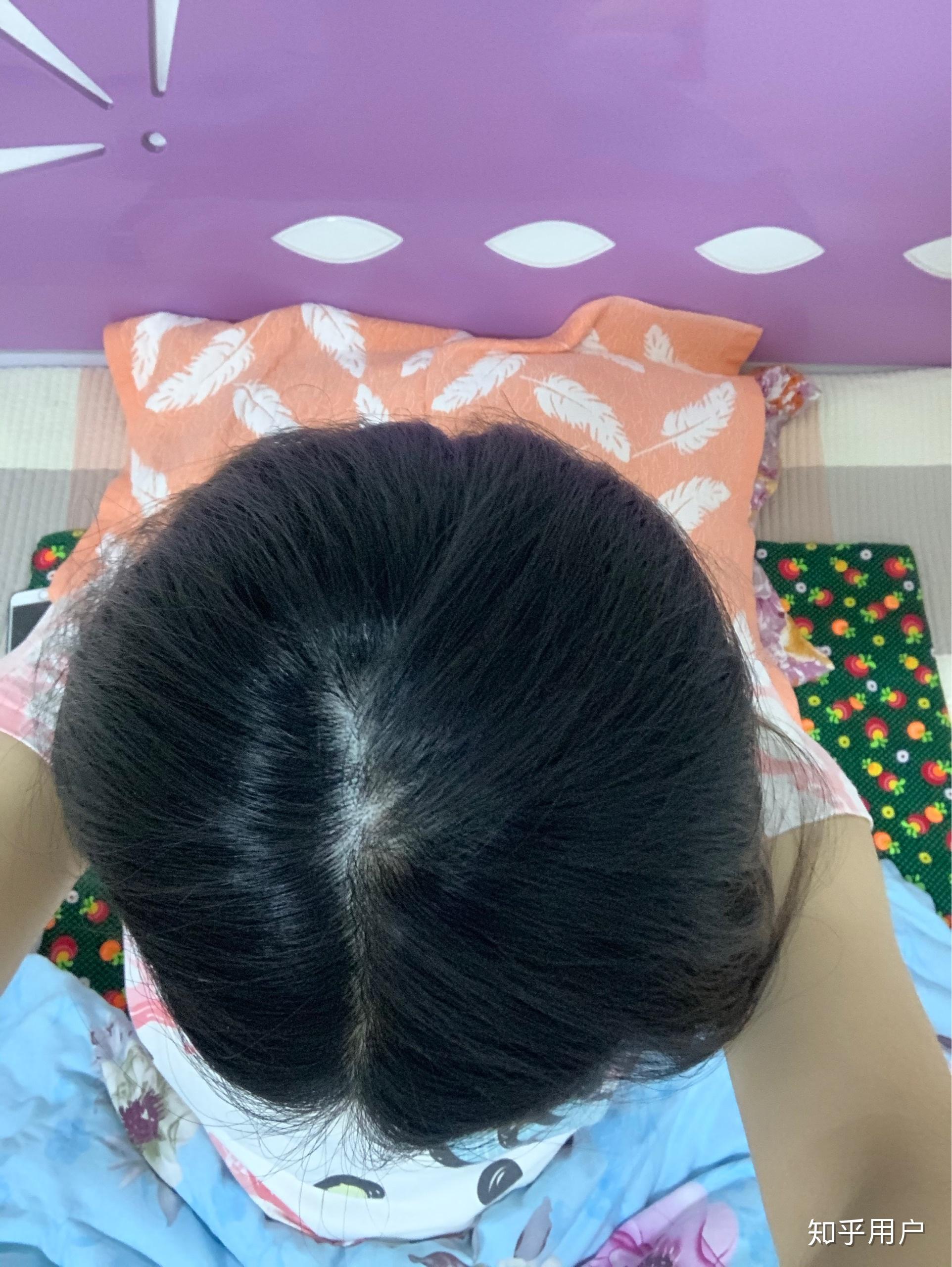 女生头顶头发少是什么体验