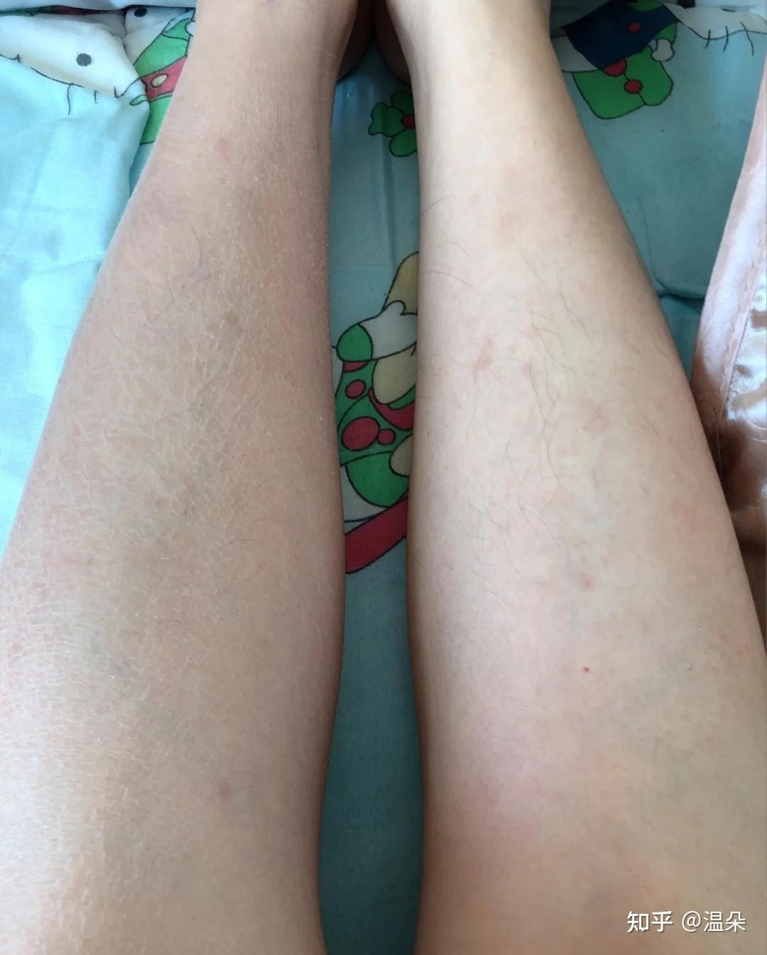 腿上有鸡皮蛇皮怎么去除