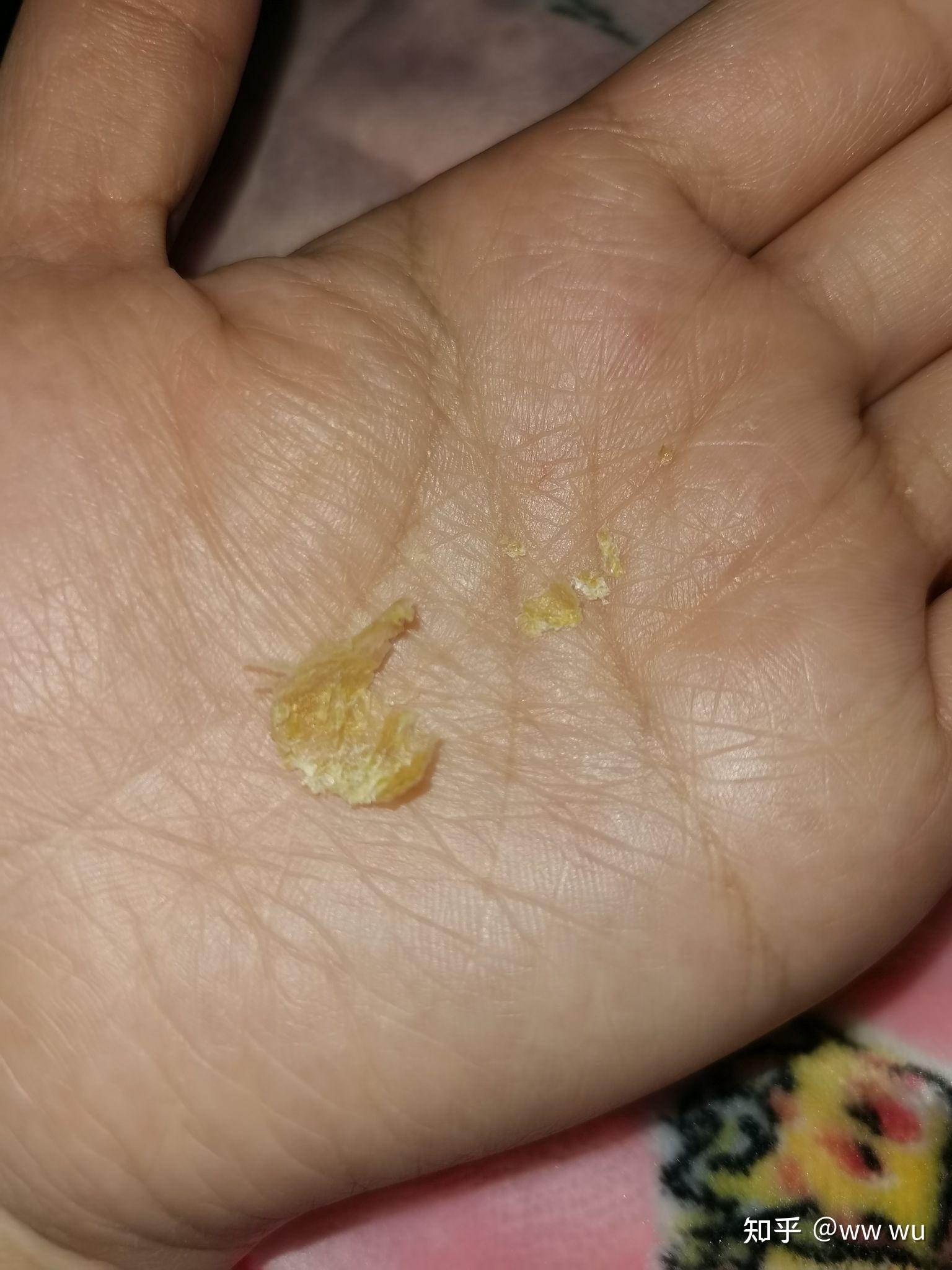 为什么我掏出来的耳屎是桶状的就是一层薄膜粘附在耳壁上