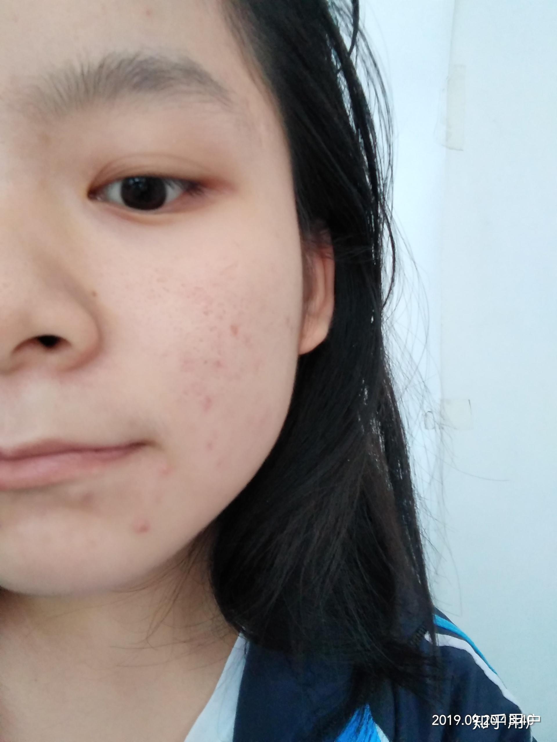 有没有长得好看但长痘痘的女生? - 知乎
