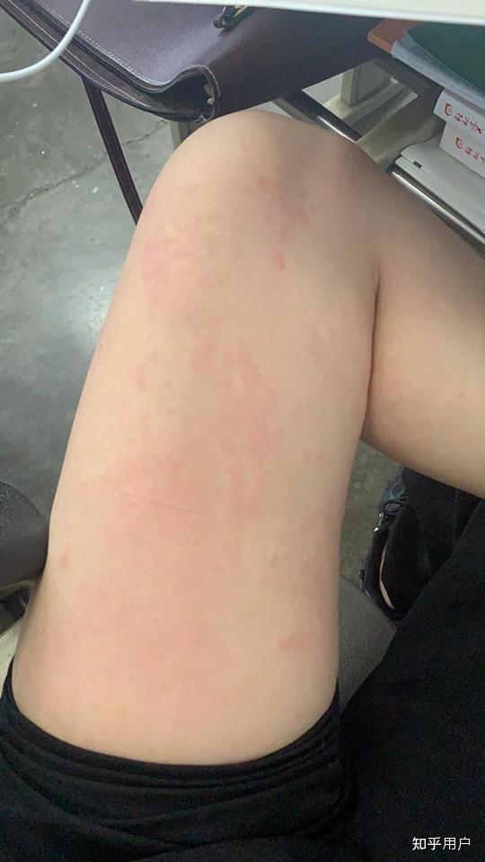 胆碱性能荨麻疹是不治之症吗?