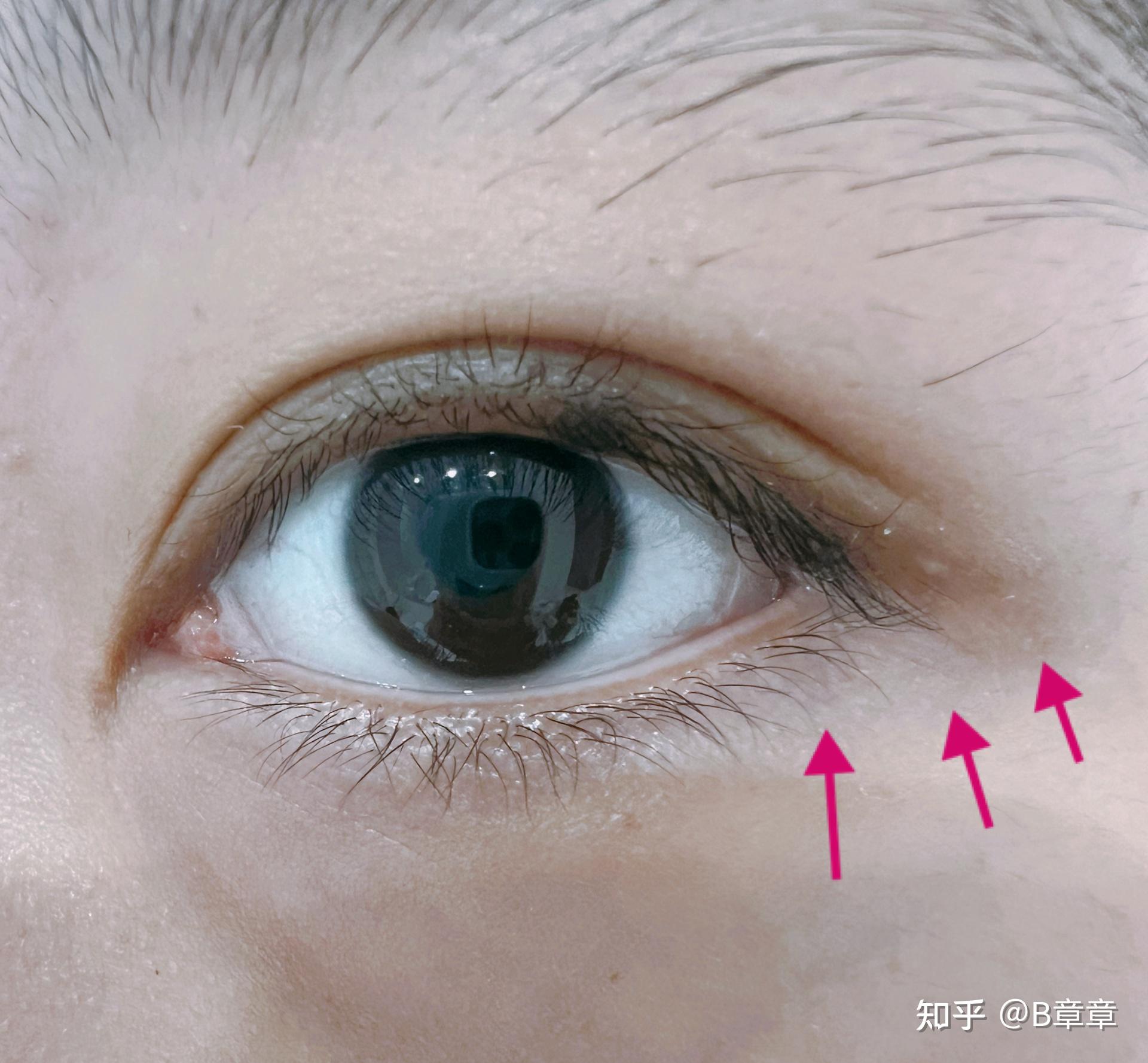 什么是双睫症?身边有这样的朋友吗? - 知乎