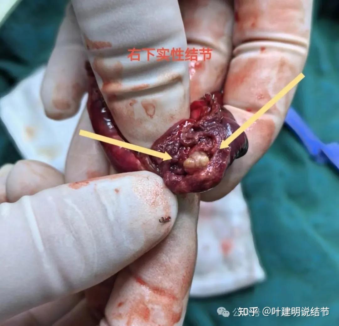 说是发现肺结节8年了,此结节或许非彼结节哟!