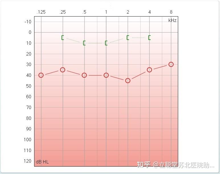 听力图的解读 - 知乎