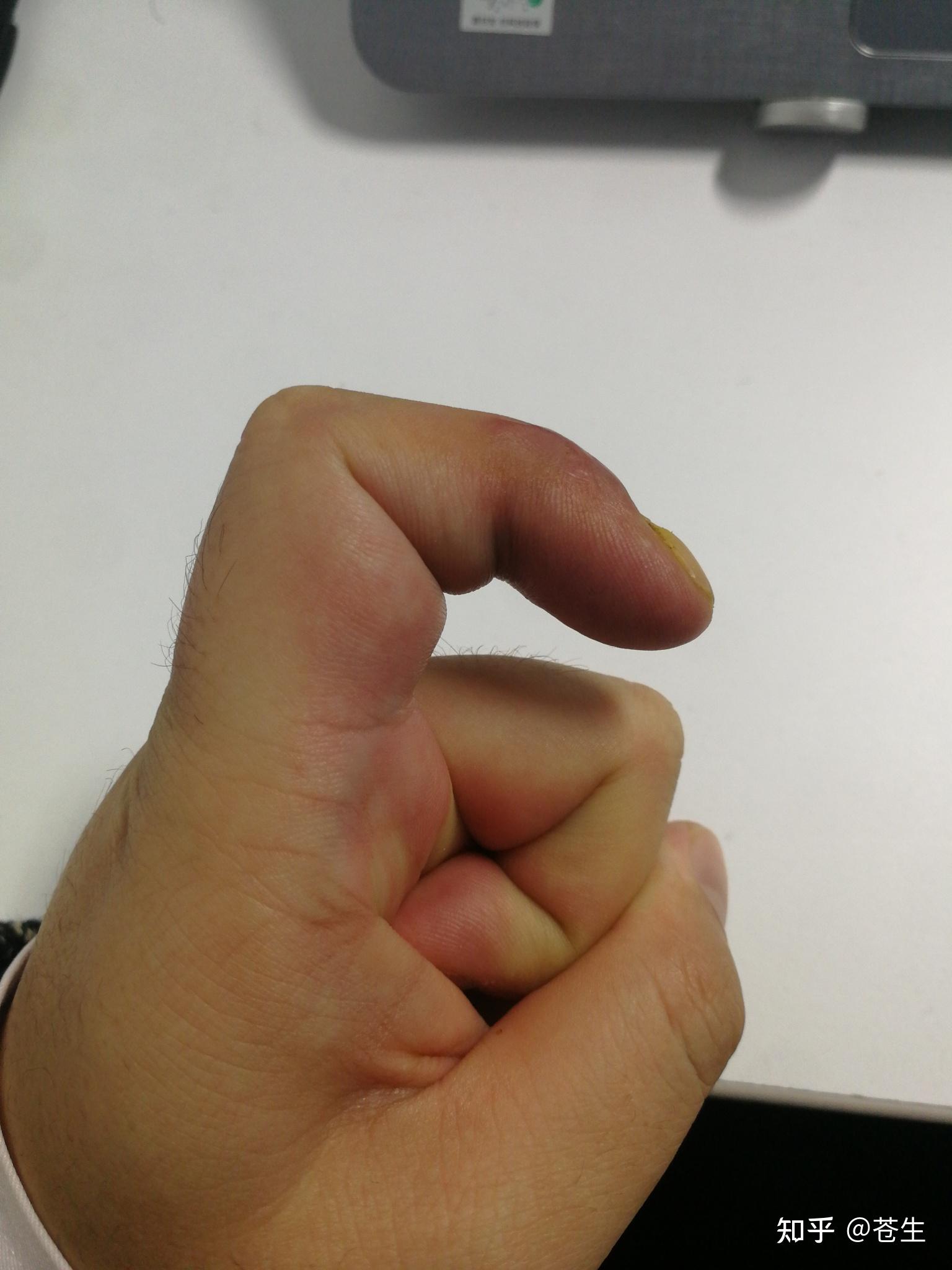 手指肌腱断裂,最后一节无法伸直.医生教我不要治疗了.请问我该怎么做?