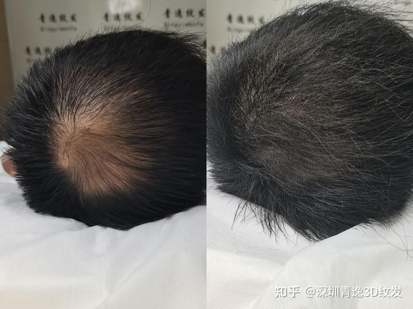 科普纹发 深圳纹发 深圳纹发机构 - 知乎