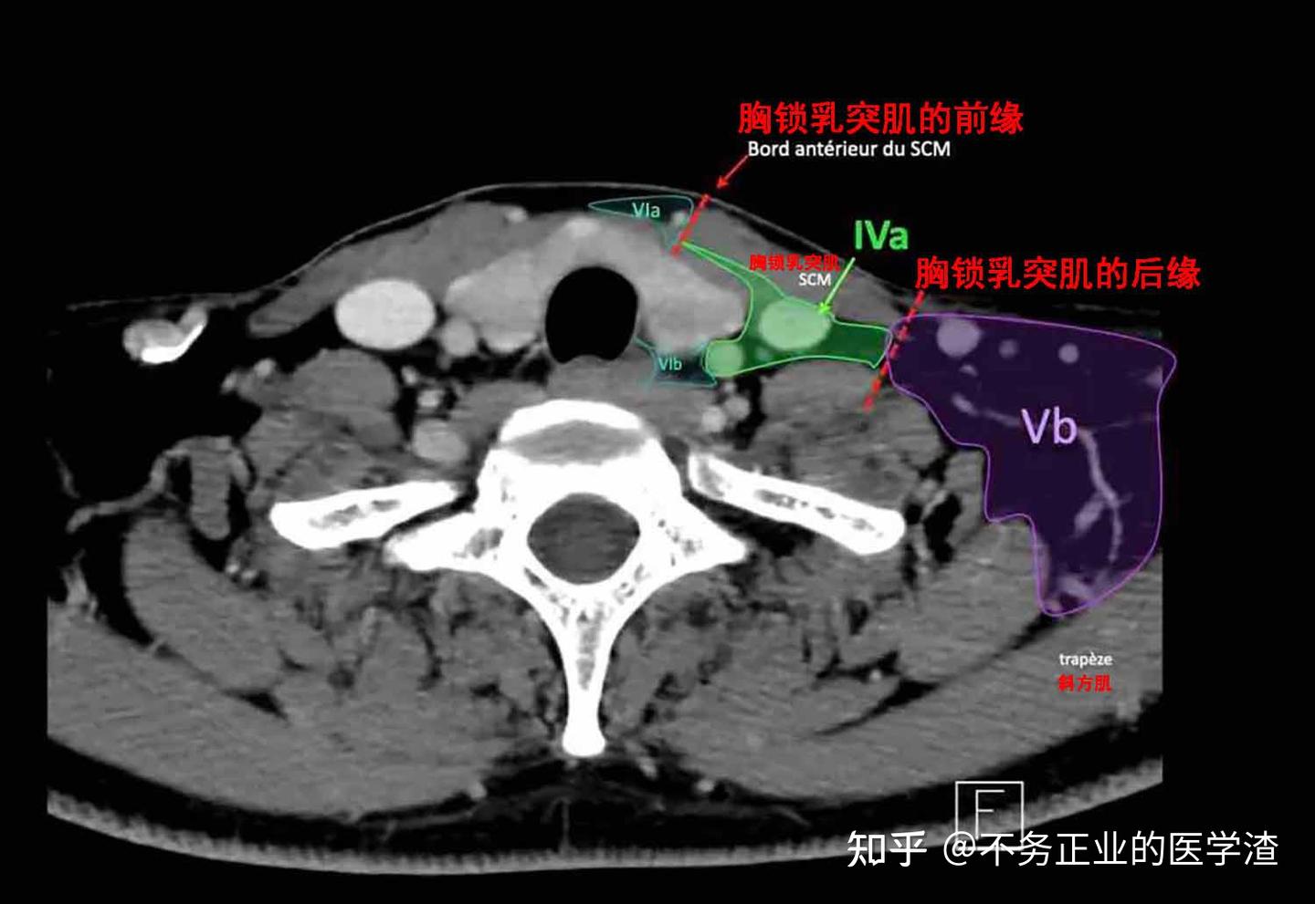 2013颈部淋巴结分区-轴位CT多图标注 - 知乎