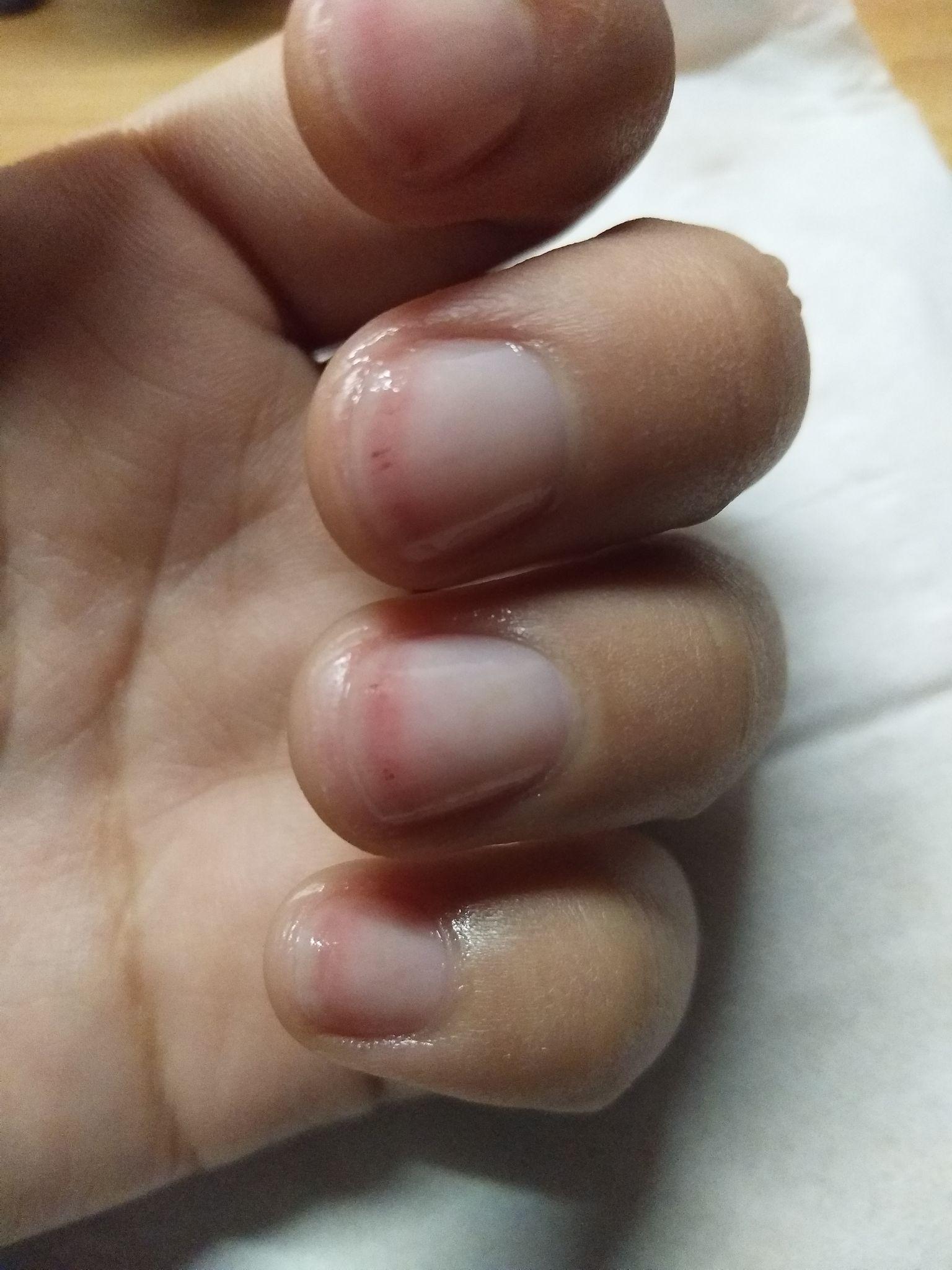 指甲下面有血丝,按压时会痛.