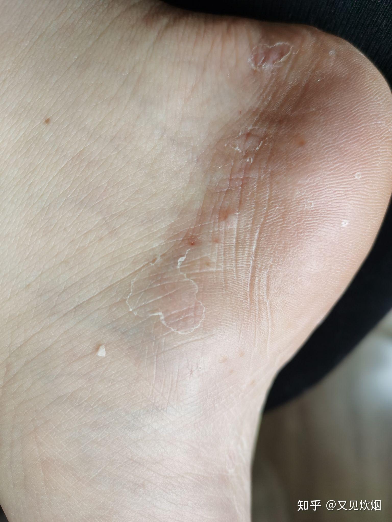 水疱型脚气水泡能扎破吗